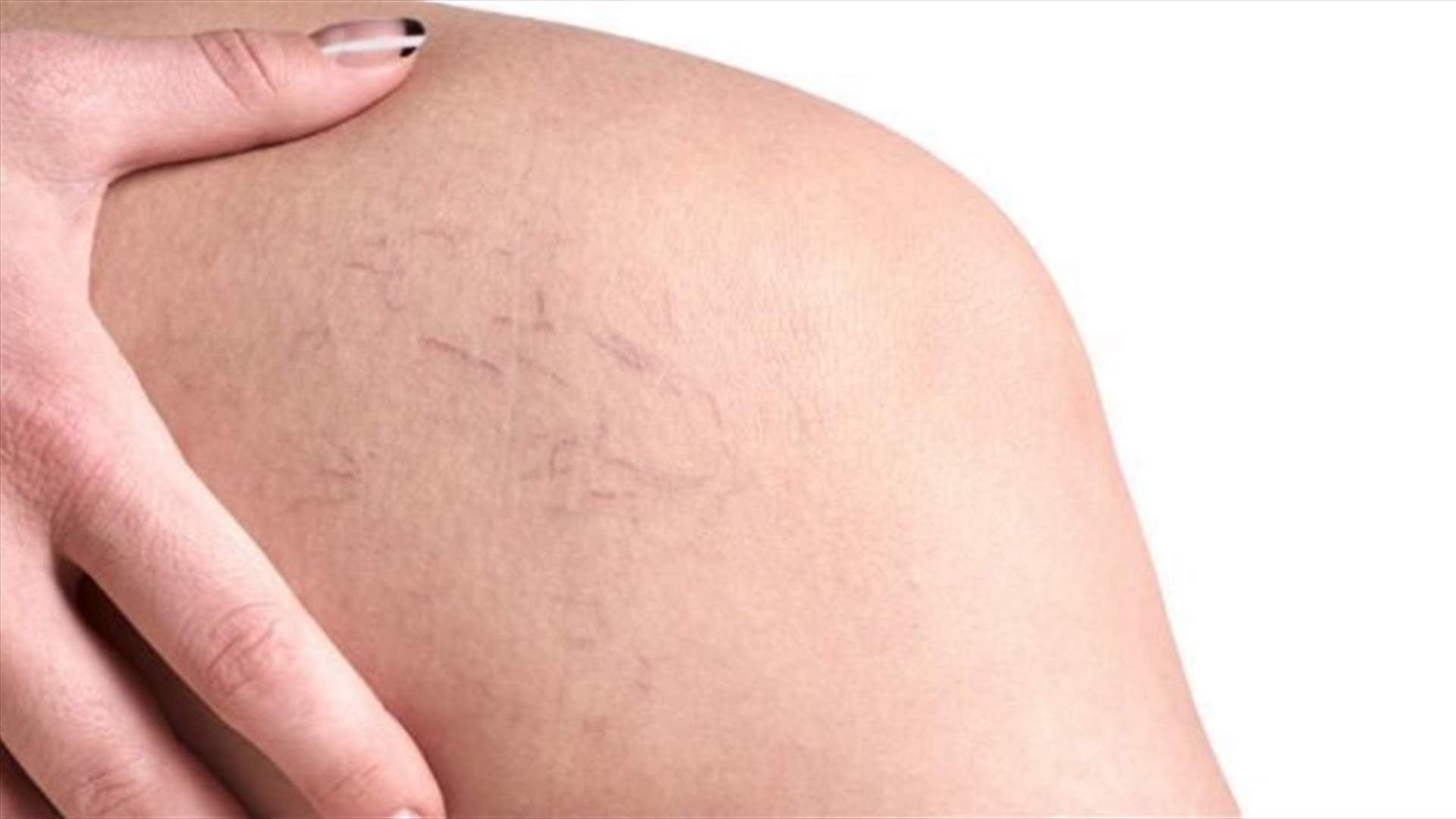علاجات منزلية للتخلّص من "عروق العنكبوت "