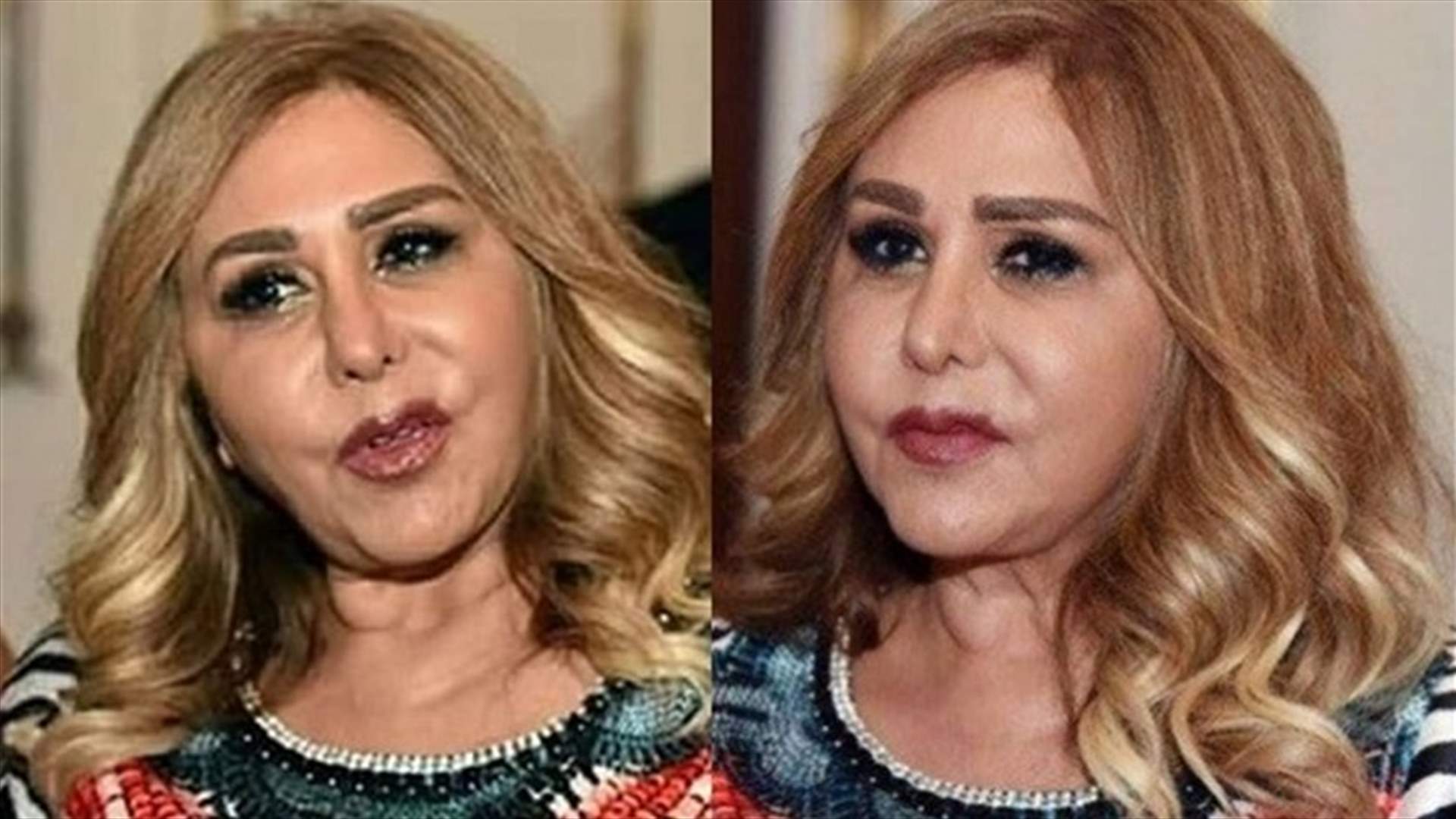 بالصورة: بعد خطأ طبي شوّه وجهها.. هل إستعادت مهى المصري جمالها؟