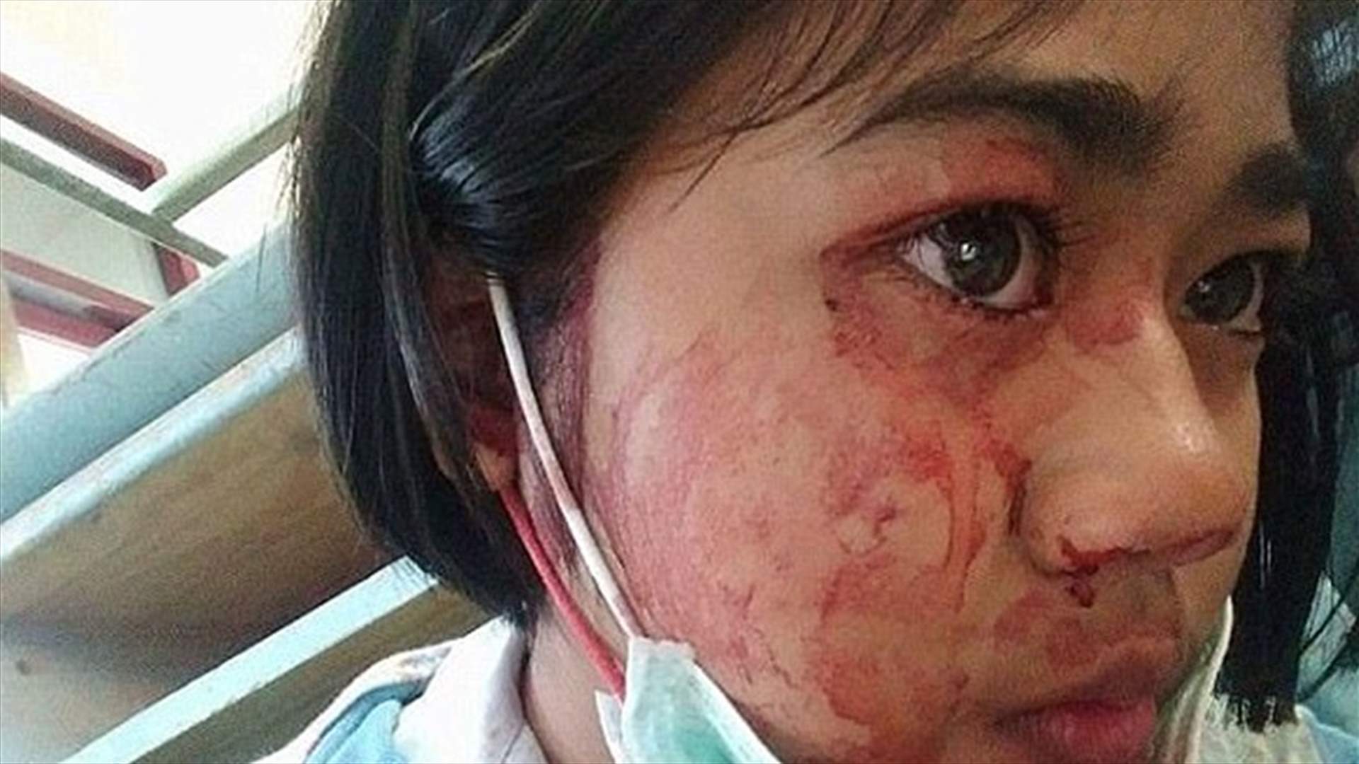 بالصور- حالة نادرة تجعلها تتعرّق "دمًا"...مريضة حيرت الأطباء!