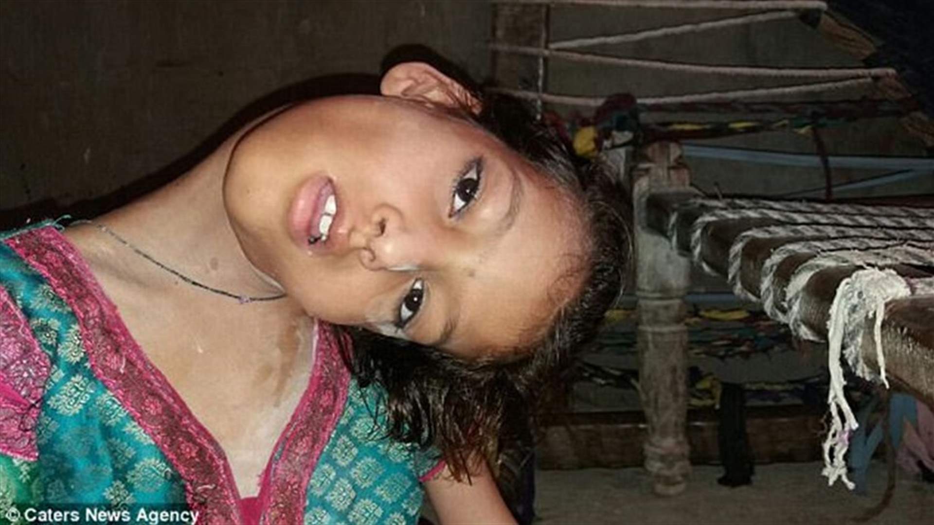 بالفيديو- حالة غريبة...فتاة عنقها ملتوٍ بنسبة 180 درجة!
