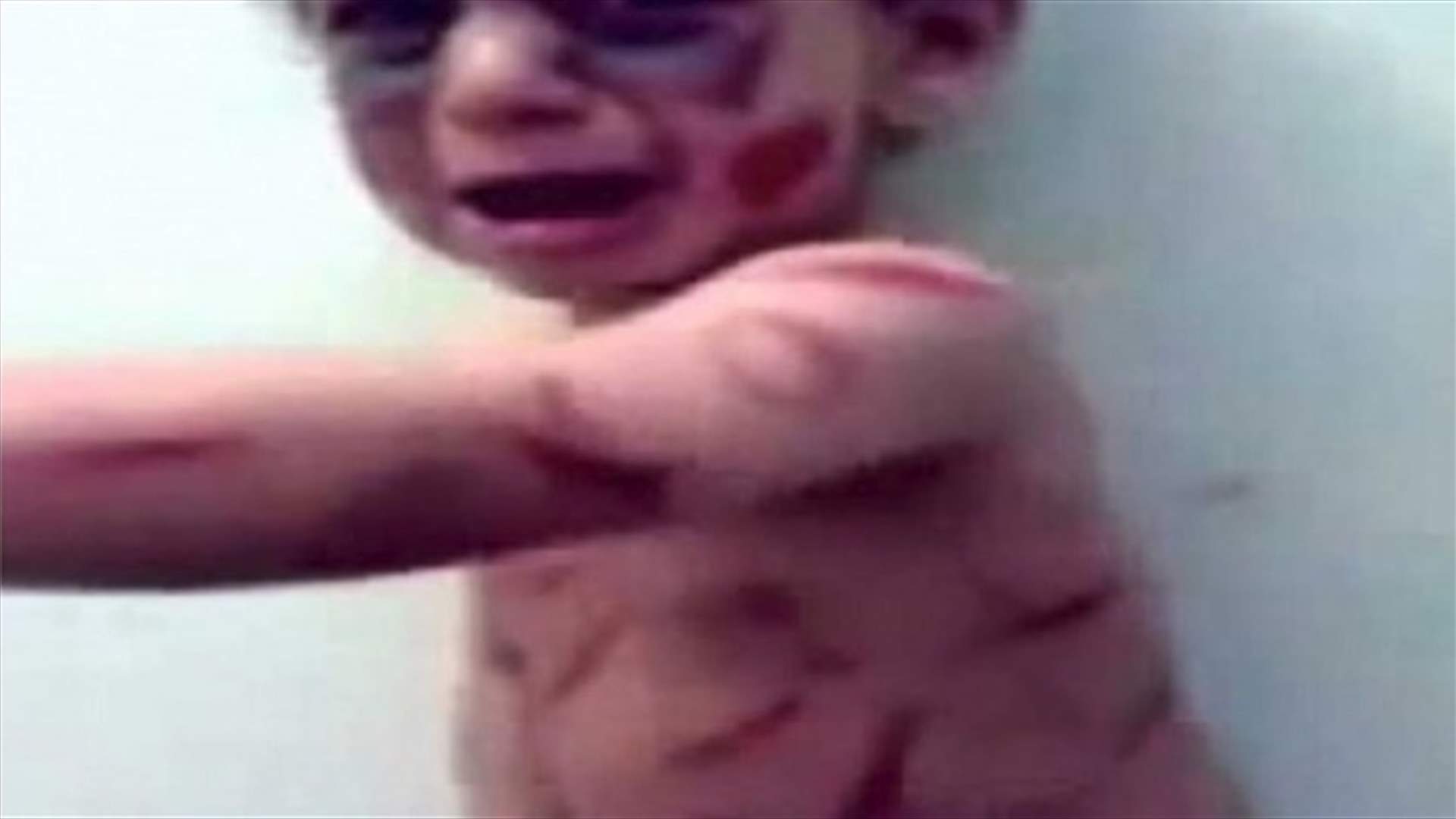 أحرقت ابنها بالسجائر وكسرت ذراعيه...