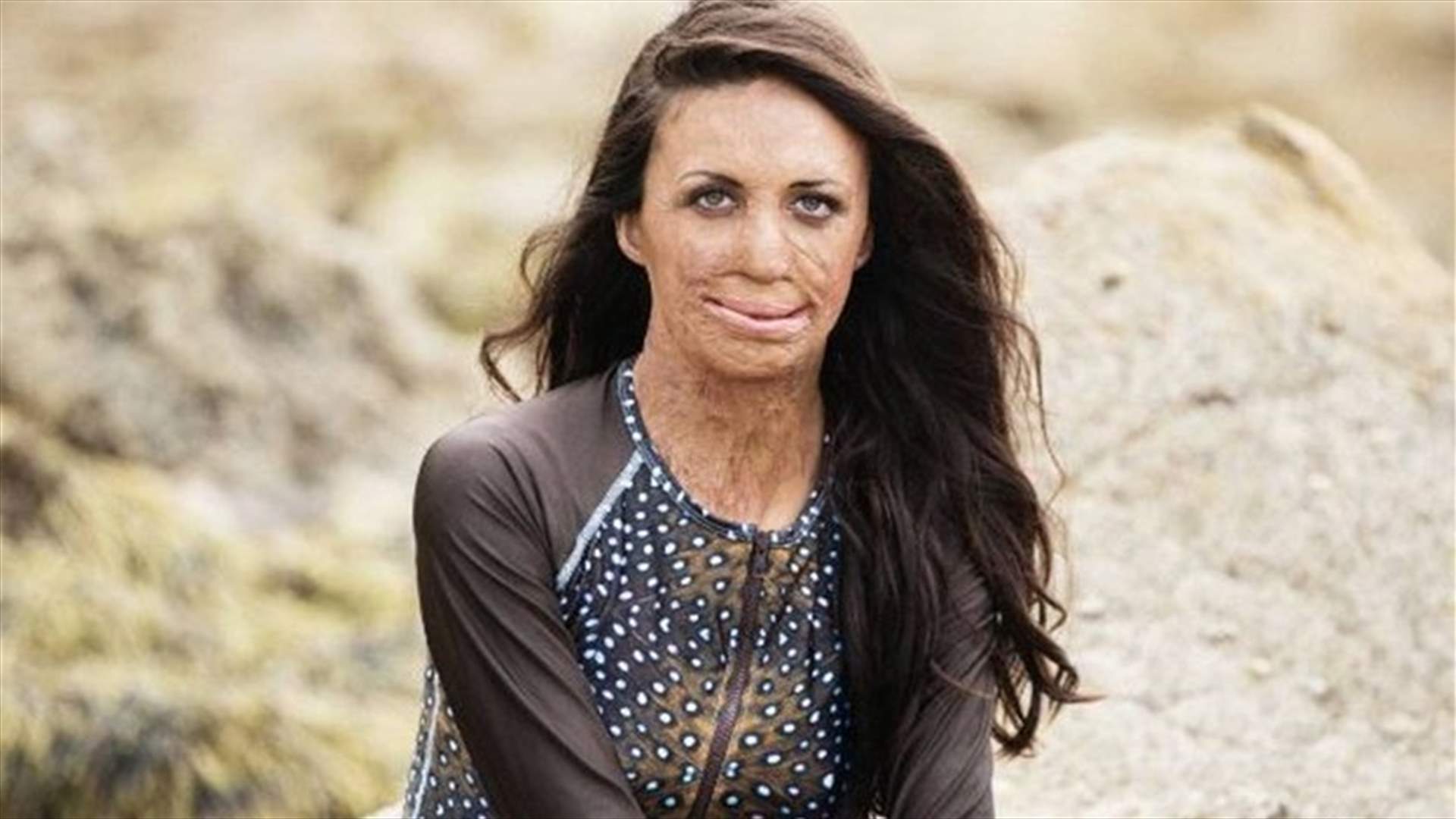 هذه الوالدة المُشوّهة كانت نجمة.. قصّتها ستفطر قلوبكم