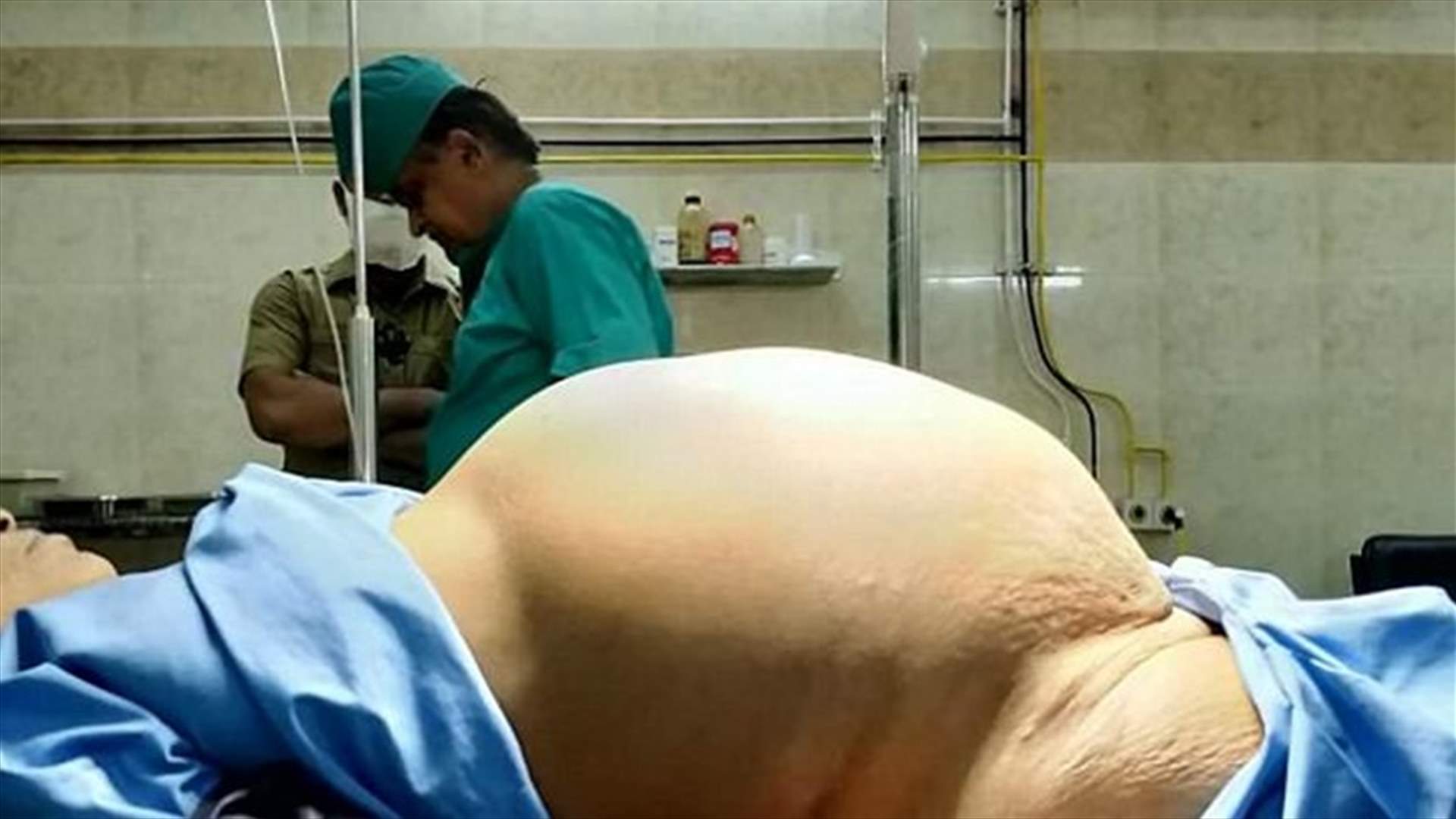 بالصور – استأصلوا من مبيضها ورماً يزن 11.8 كيلوغراما!