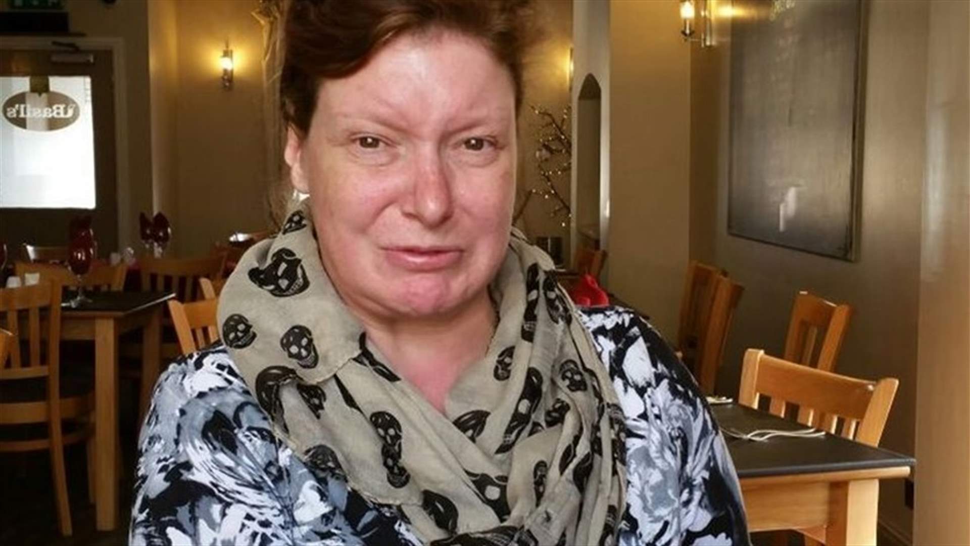 لم تبتسم منذ أكثر من 30 سنة بسبب اصابتها بحالة نادرة!