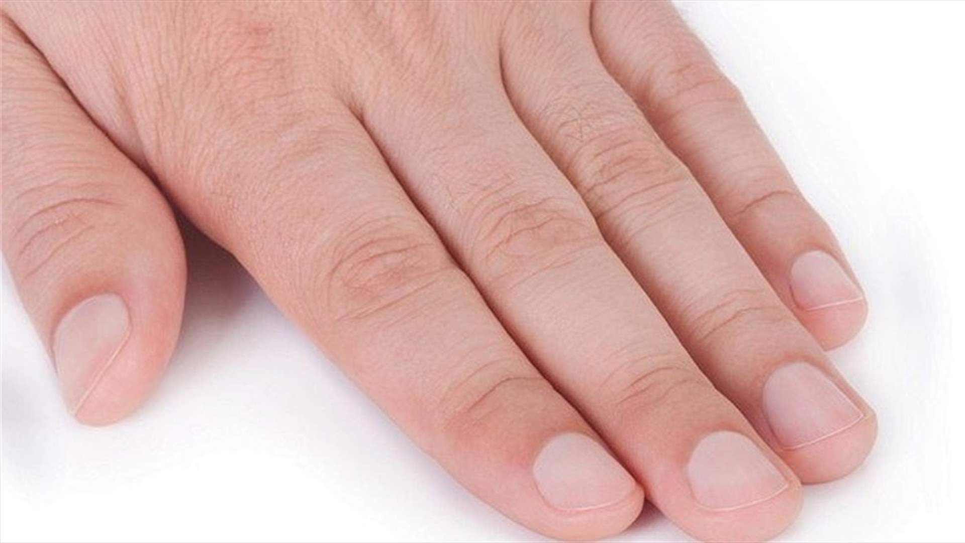 بالصور- حالة نادرة حيّرت الأطباء... ماذا نما فوق ظفر رجل؟