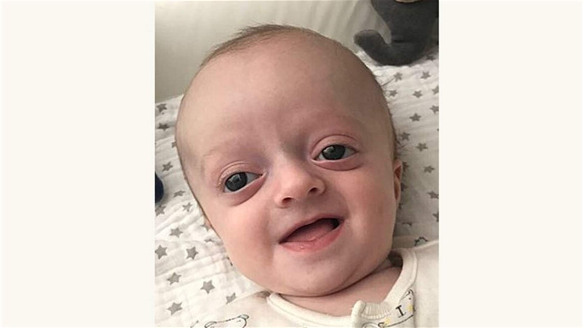 ما هي متلازمة كروزون؟ وما هي أسبابها؟