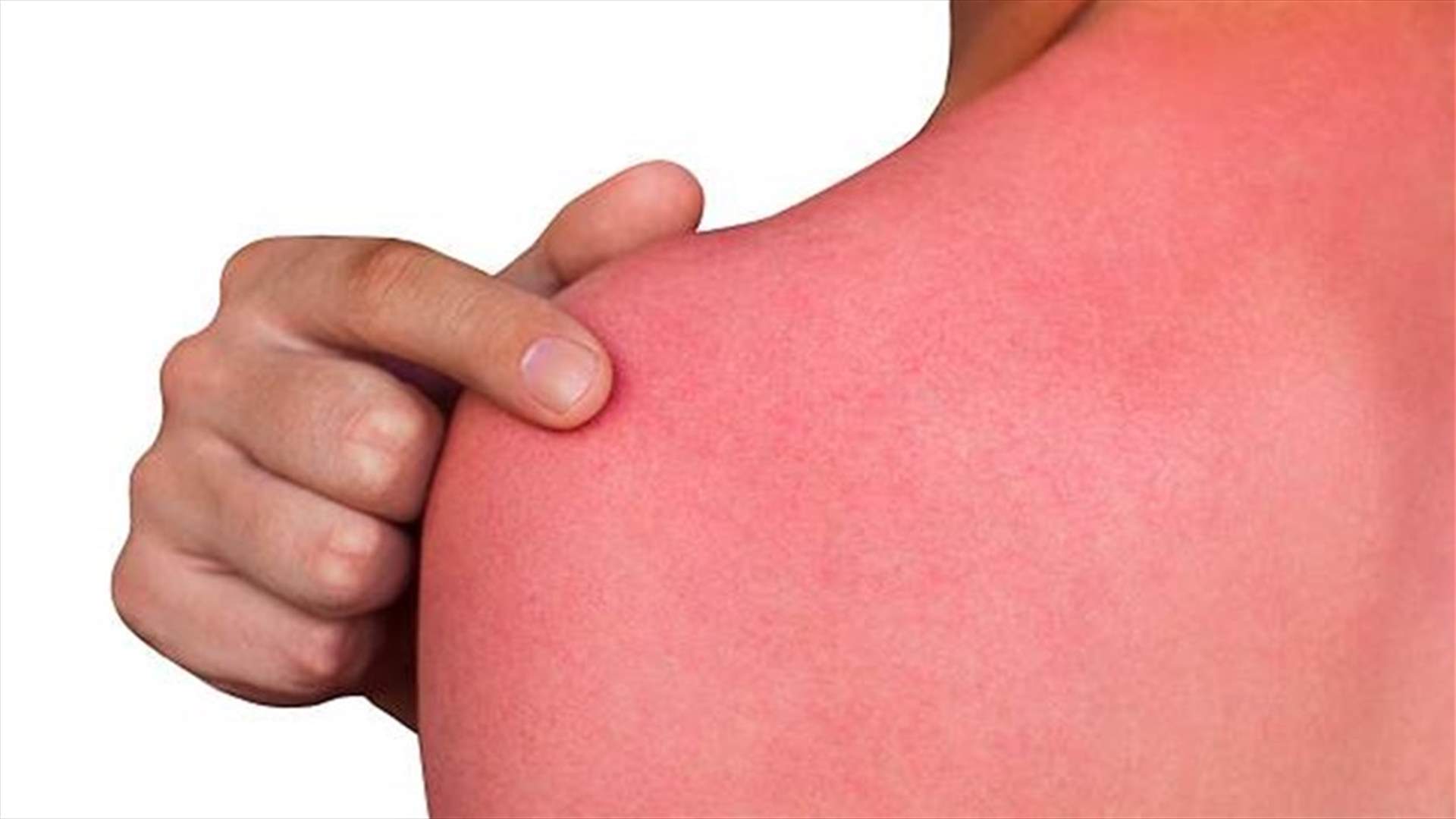 مكوّن تجدونه في البراد مثالي لعلاج حروق الشمس