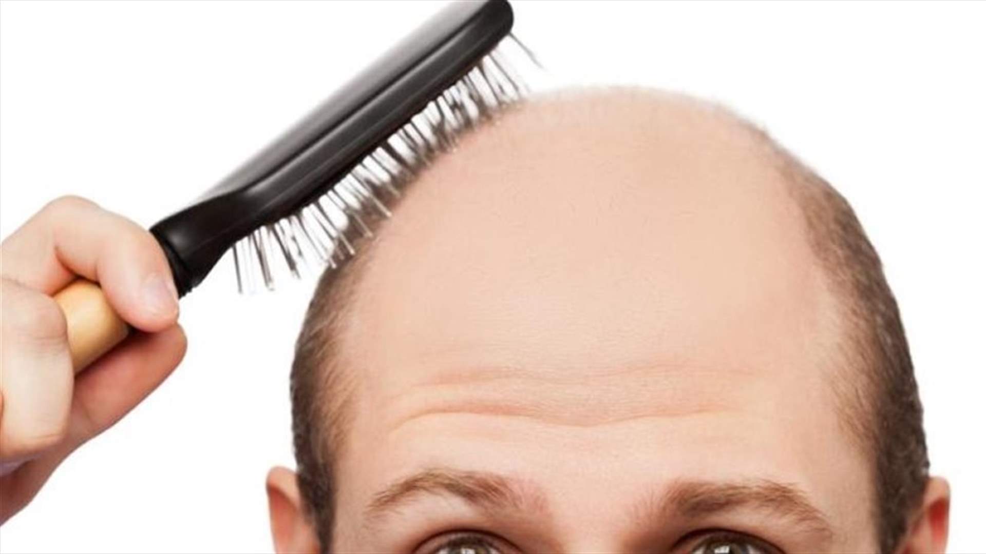 اكتشاف علاج جديد محتمل للصلع!