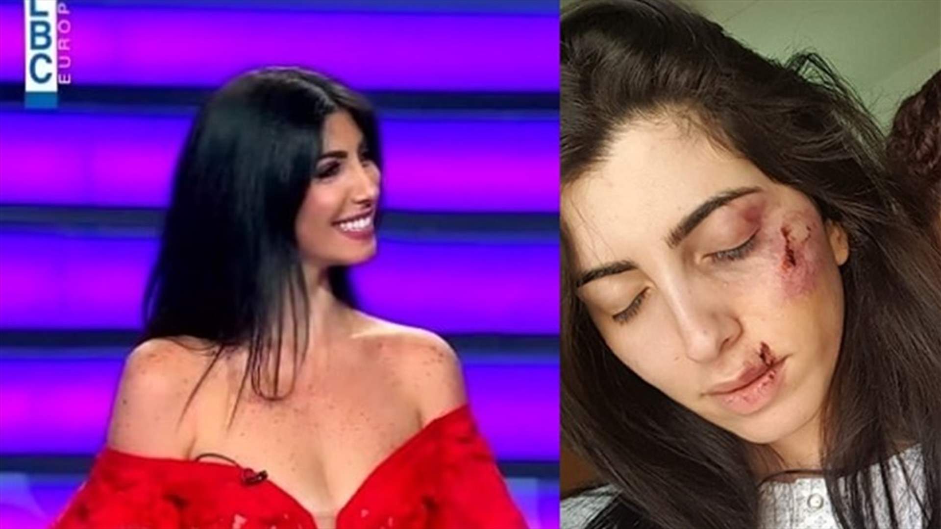 نجمة "نقشت" كريستال الحاج بوجهٍ مشوّه.. صورها أثارت القلق!