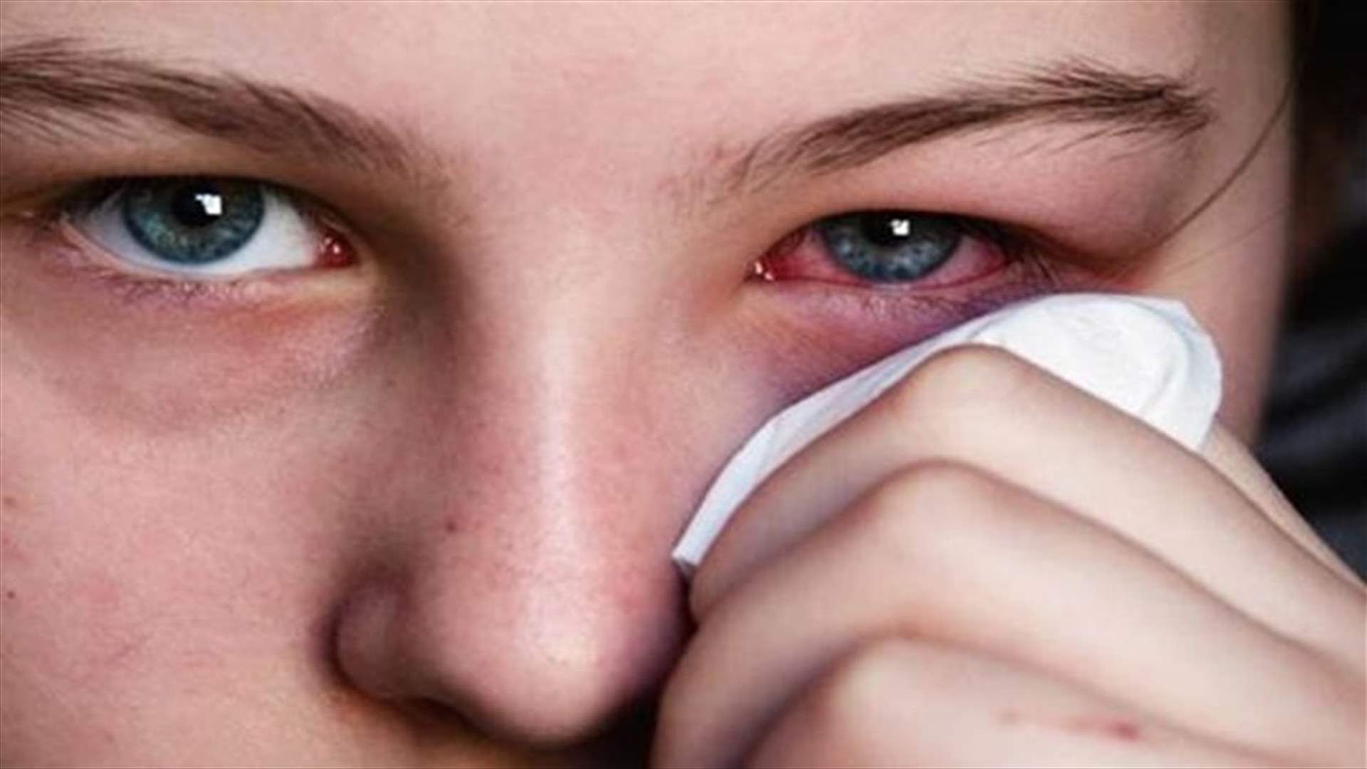علاجات منزلية للتخلّص من ألم العين واحمرارها
