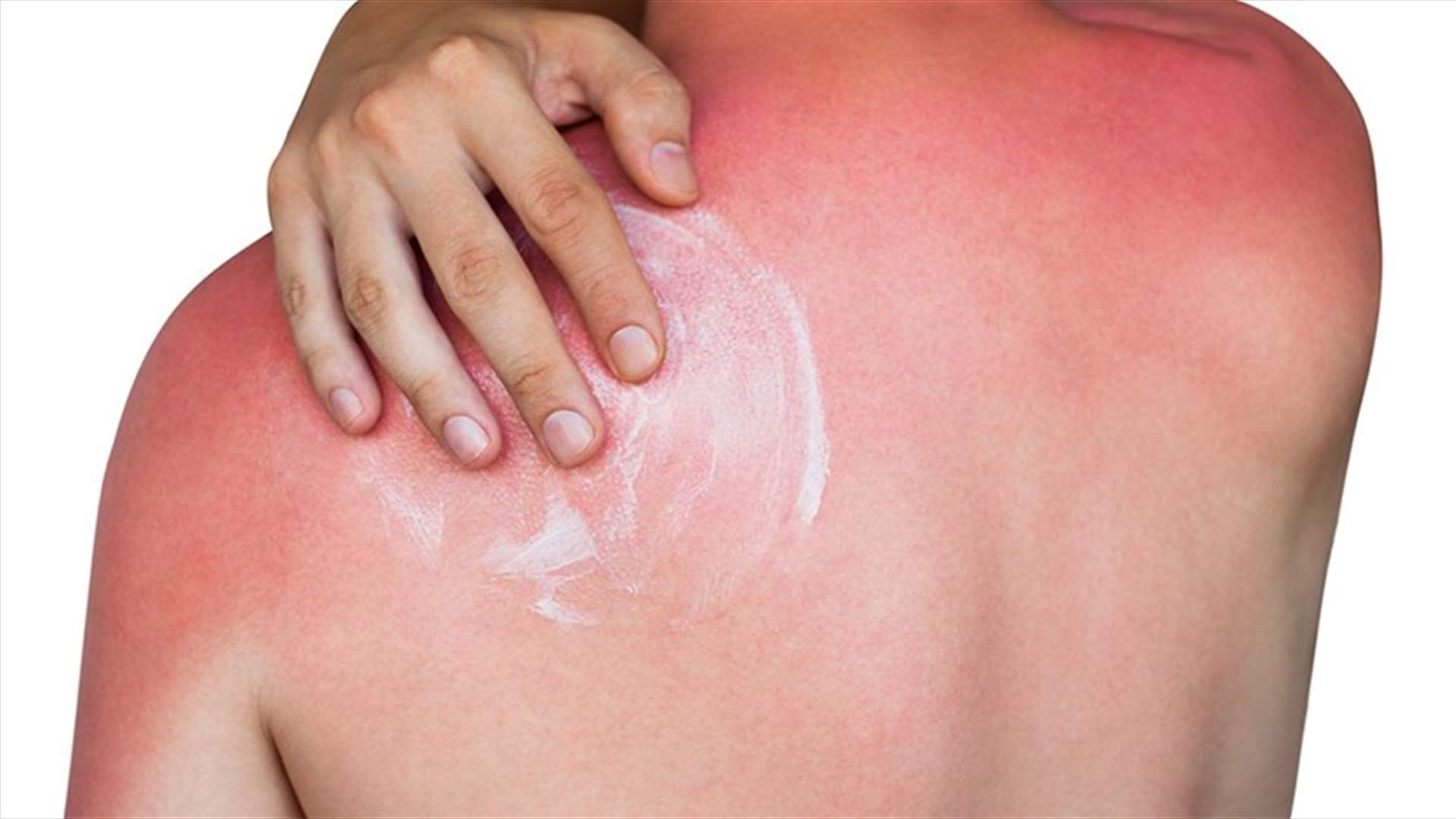عالجوا حروق الشمس باستخدام مستحضر تجدونه في كل منزل