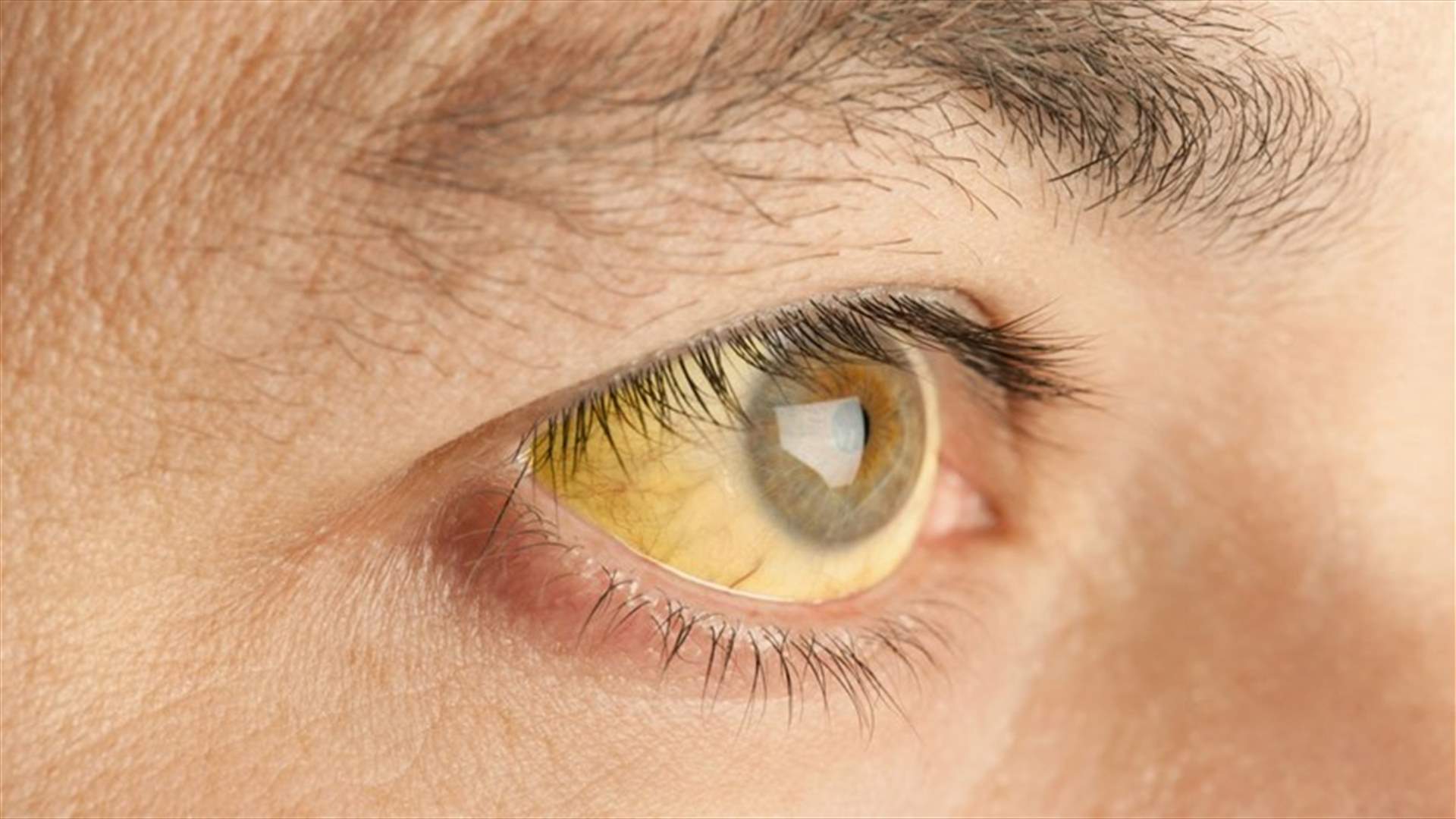 انتشار حالات "مرض اليرقان" في عين الذهب... والأهالي يناشدون وزارة الصحة