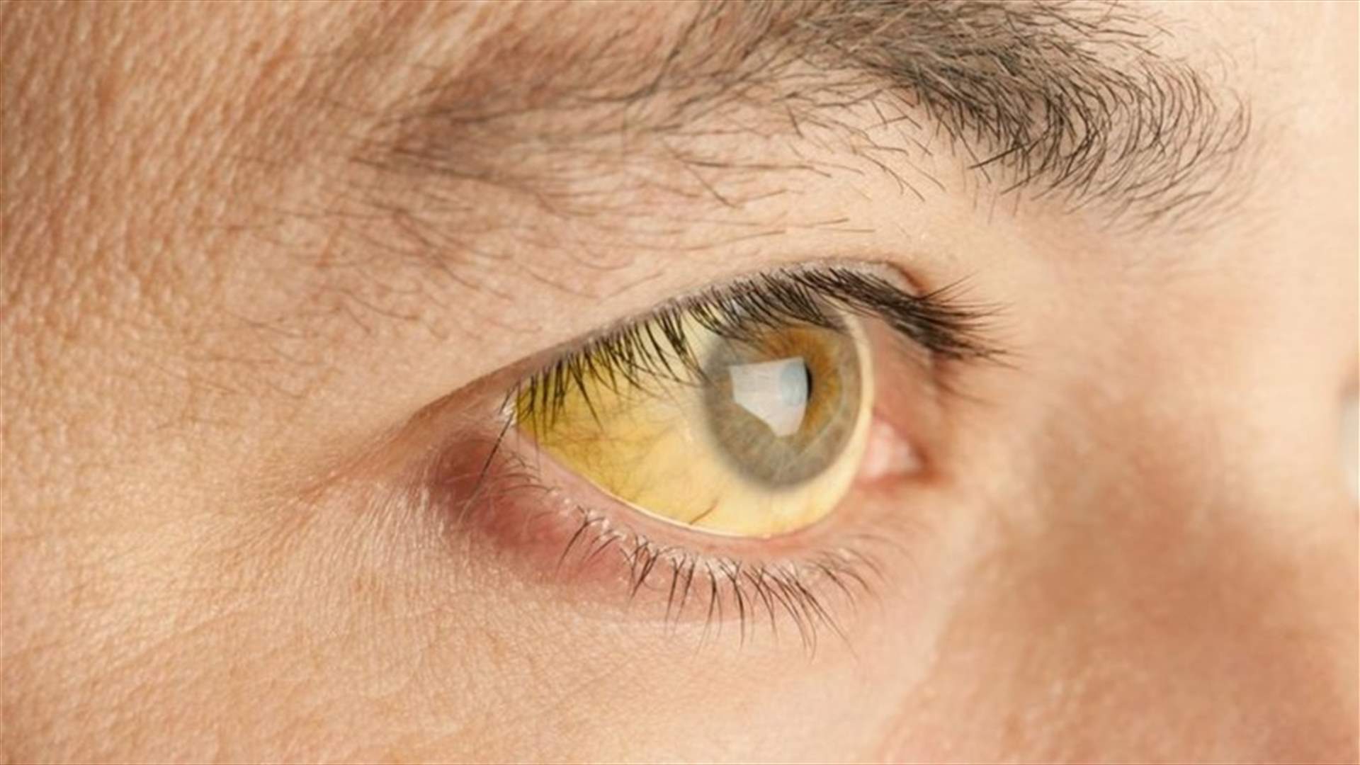 إصابات باليرقان في اللبوة... والصحة تأخذ عينات من المياه للتأكد من سلامتها