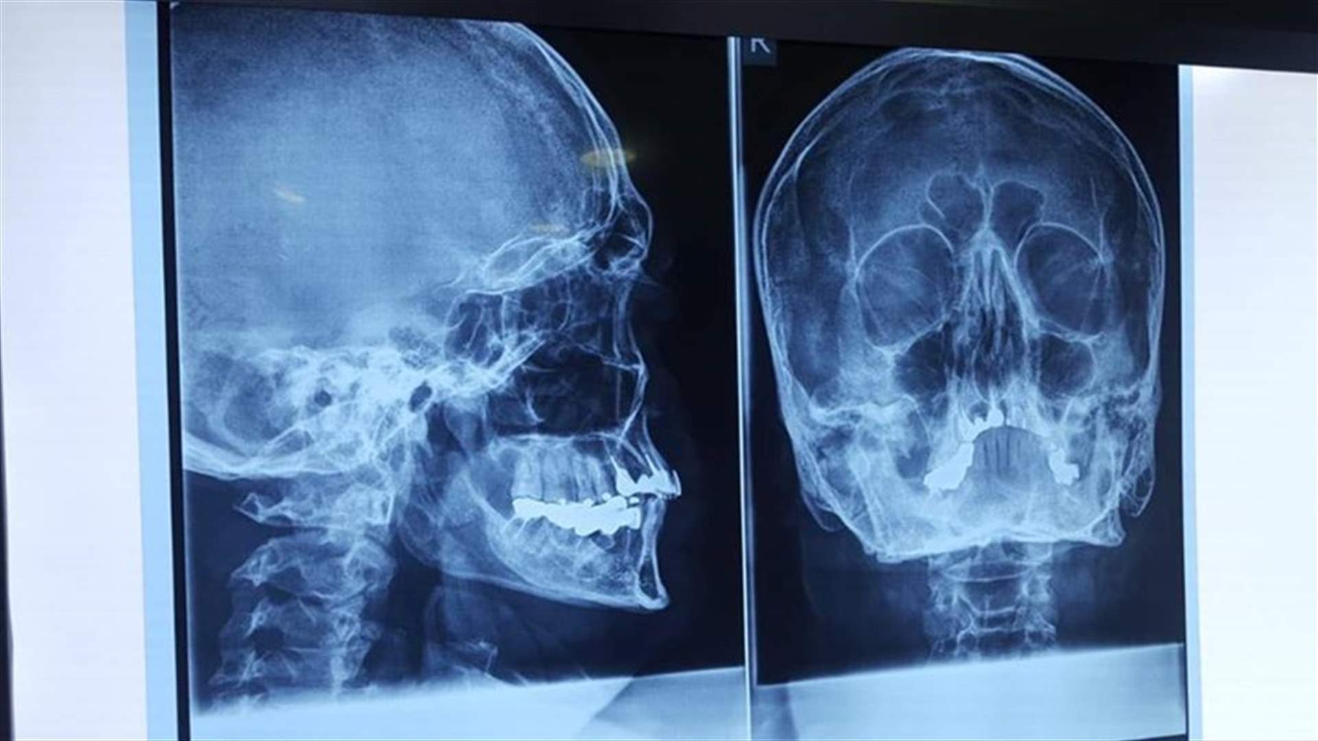 فنان لبناني يتعرّض للضرب المبرح على مدخل جامعة الكسليك.. الكدمات على وجهه بالصور