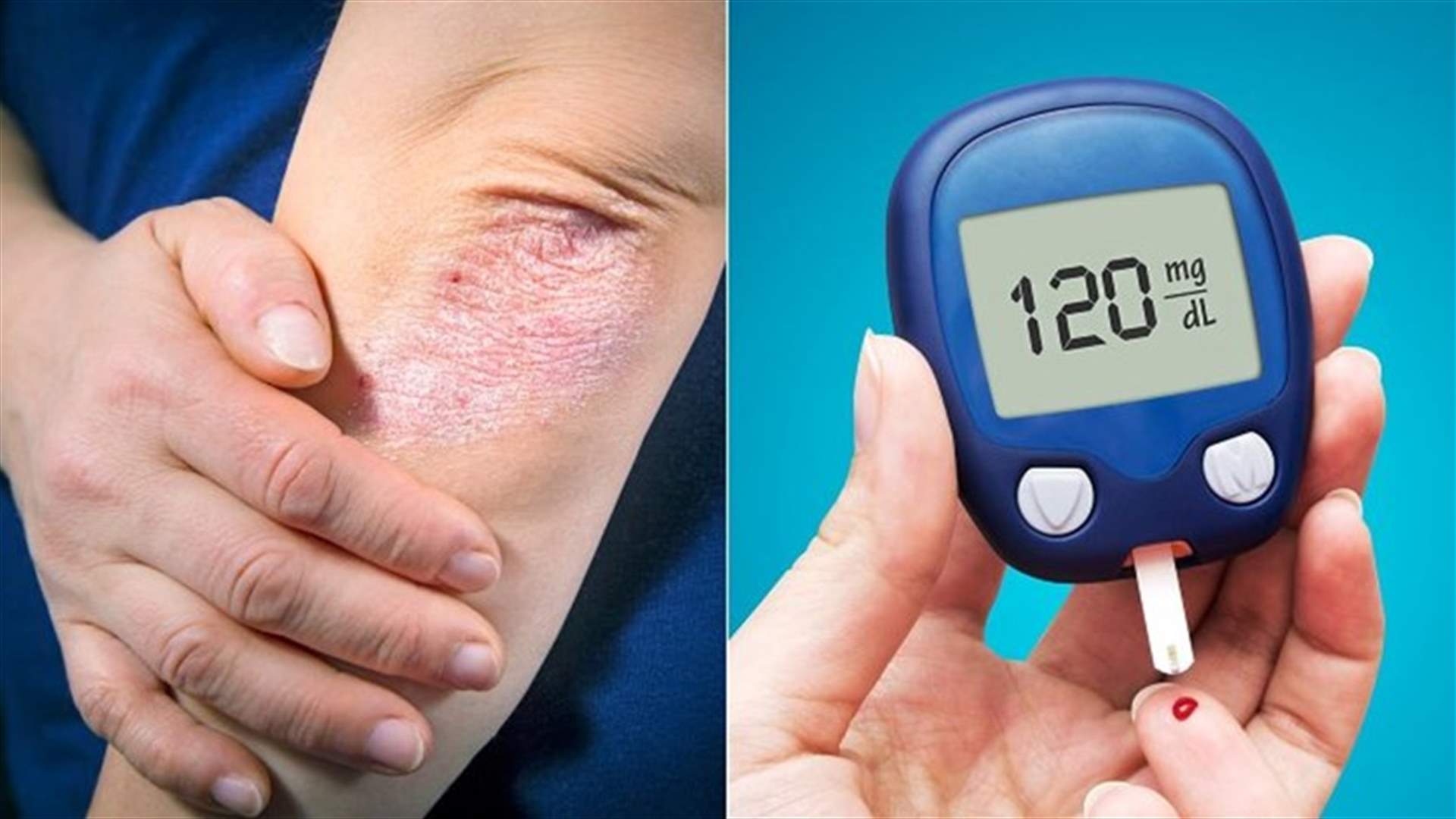 ما هي العلاقة بين الإصابة بمرض الصدفية وزيادة خطر داء السكري؟