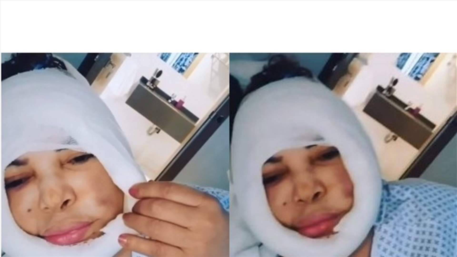 فيديو فلّة الجزائرية قبل حذفه.. إنتفاخ في وجهها وشفتيها داخل المستشفى!