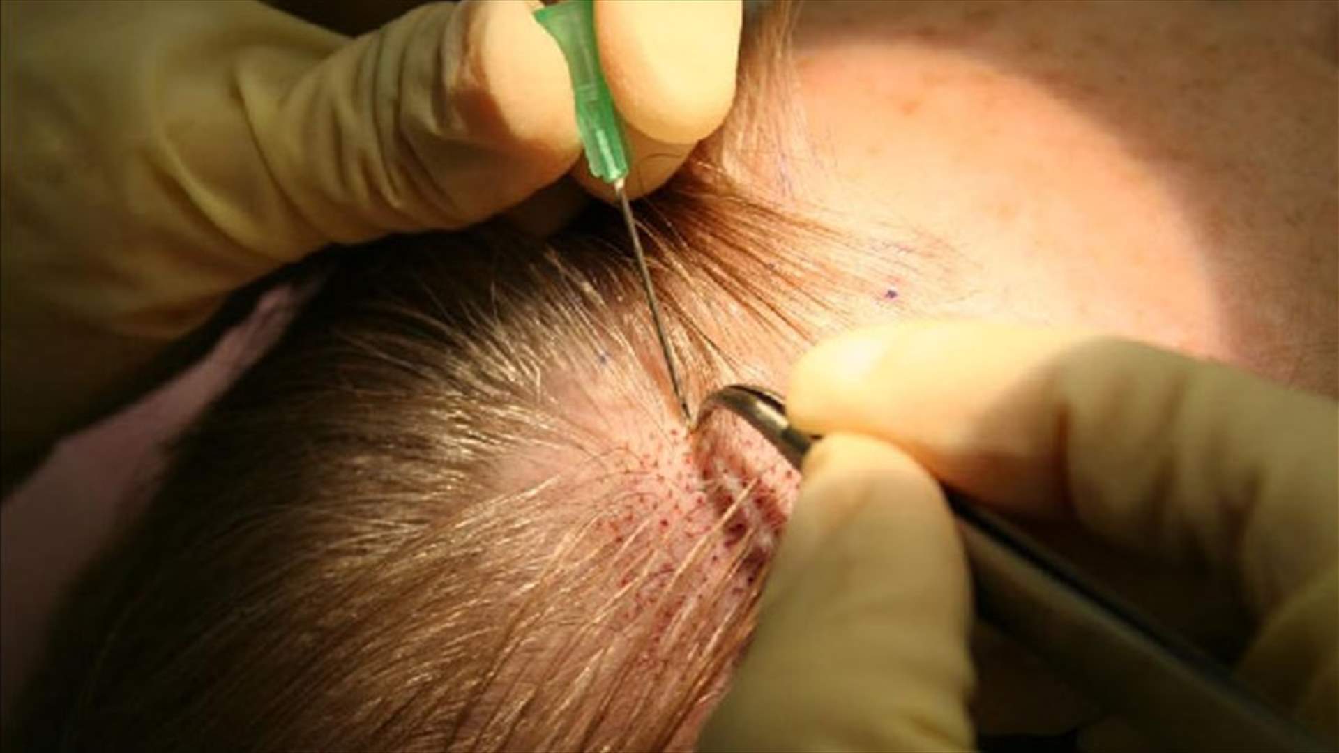 وفاة رجل أعمال هندي بعد خضوعه لعملية زرع شعر استغرقت 12 ساعة