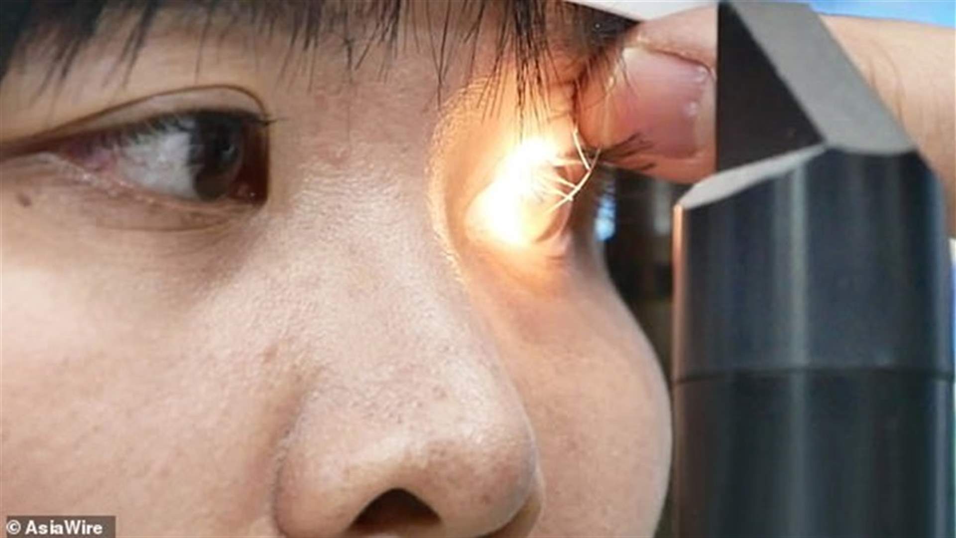في حالة قد تكون الأولى في العالم... 4 نحلات في عين فتاة عشرينية (صور)