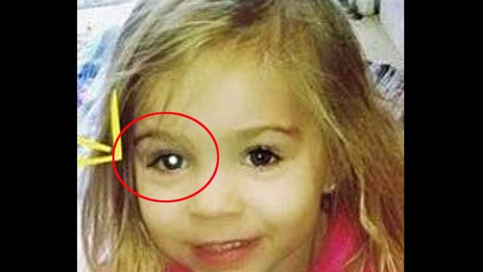 10 أورام خبيئة في عين طفلة... صورة كشفت مرضها الخطير