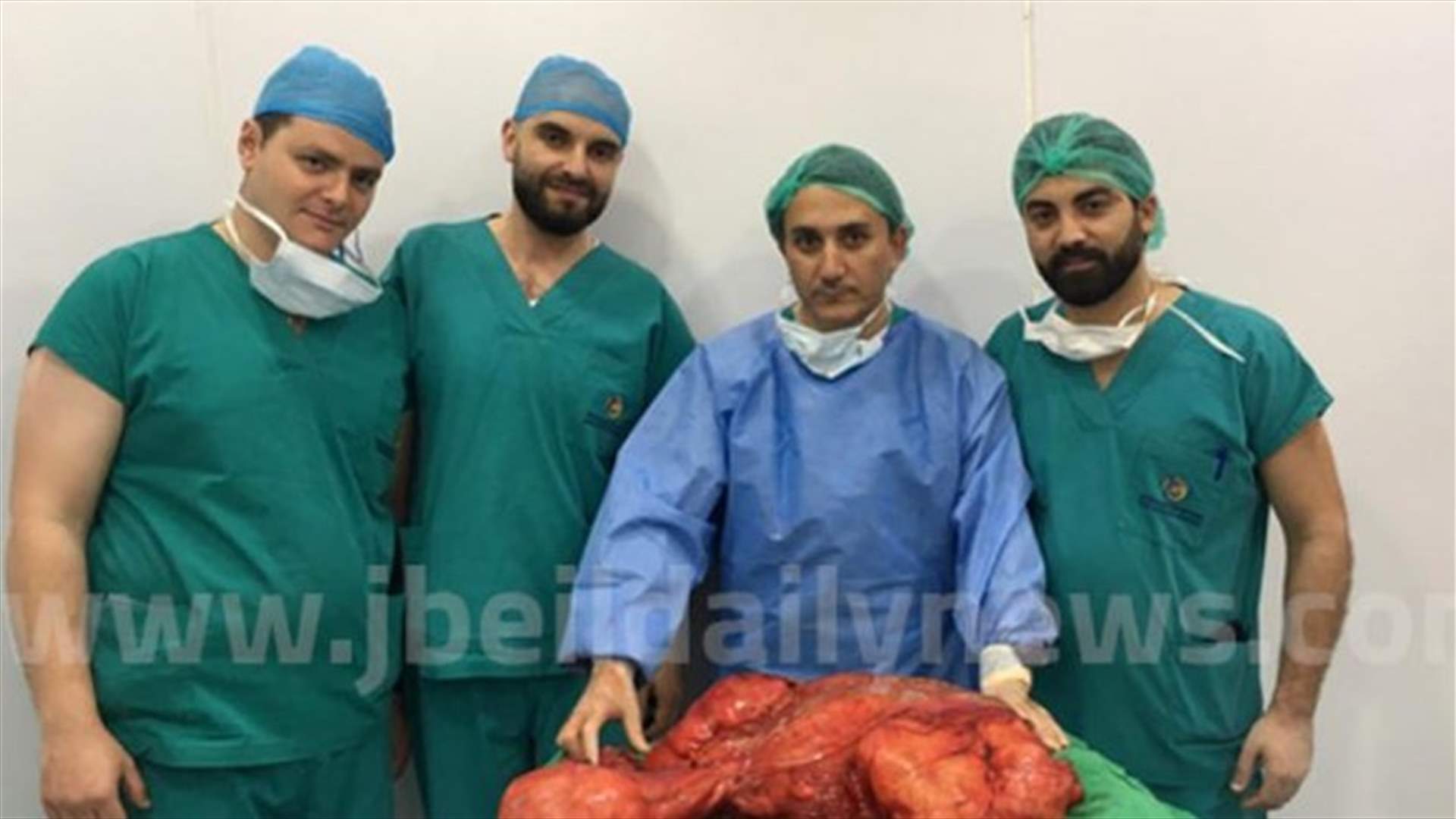 في مستشفى سيدة المعونات... استئصال ورم ضخم من بطن رجل