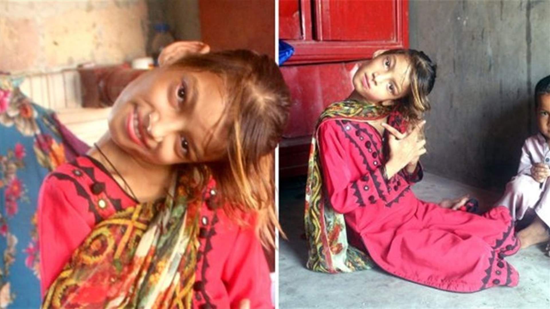طفلة عاشت كلّ حياتها بعنقٍ ملتوٍ 90 درجة... وعملية جراحية قد تُغيّر حياتها