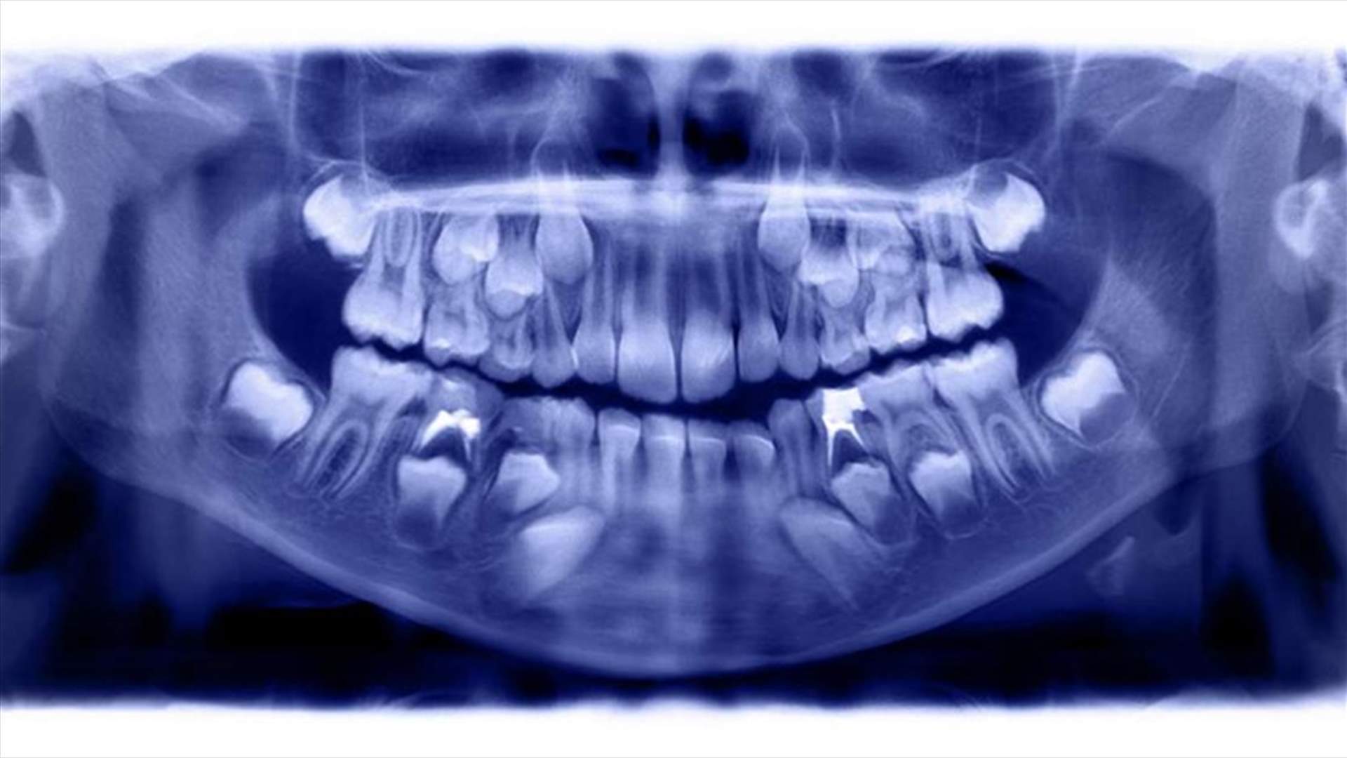 حالة طبية تثير الذهول... الأطباء يقتلعون أكثر من 500 سن من فم طفل