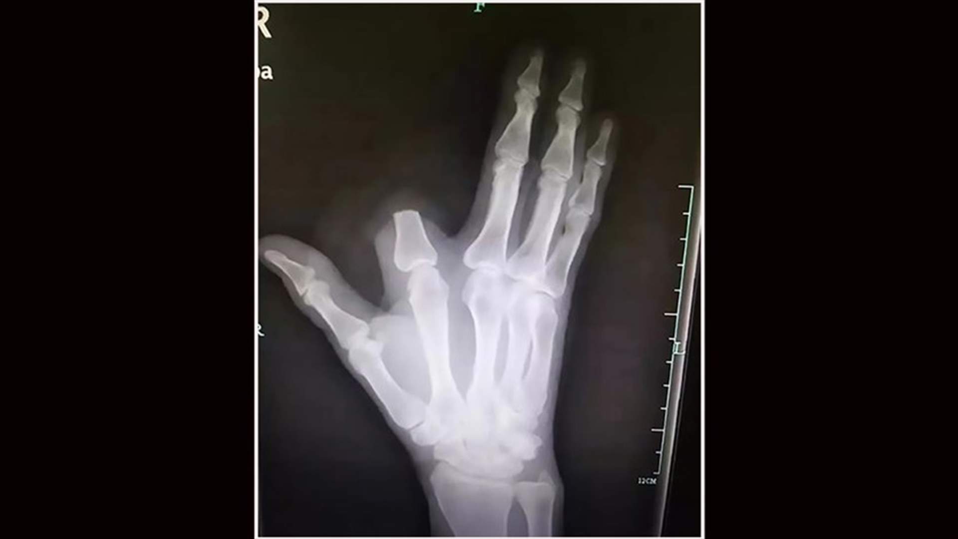 قطع اصبعه بعد تعرّضه للدغة... ثمّ اكتشف أمراً مهماً