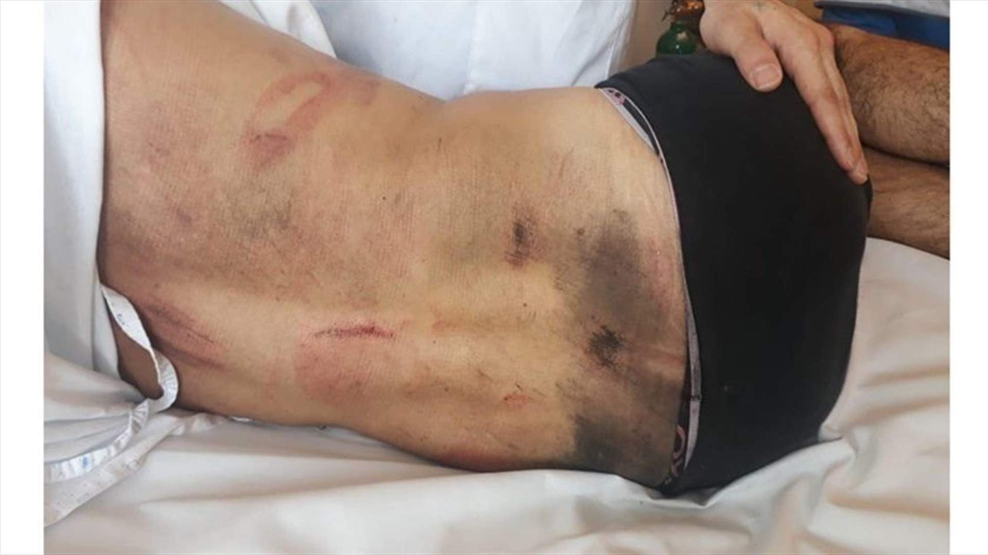 Photos show bruises on protester’s body as result of beating in Jal el-Dib