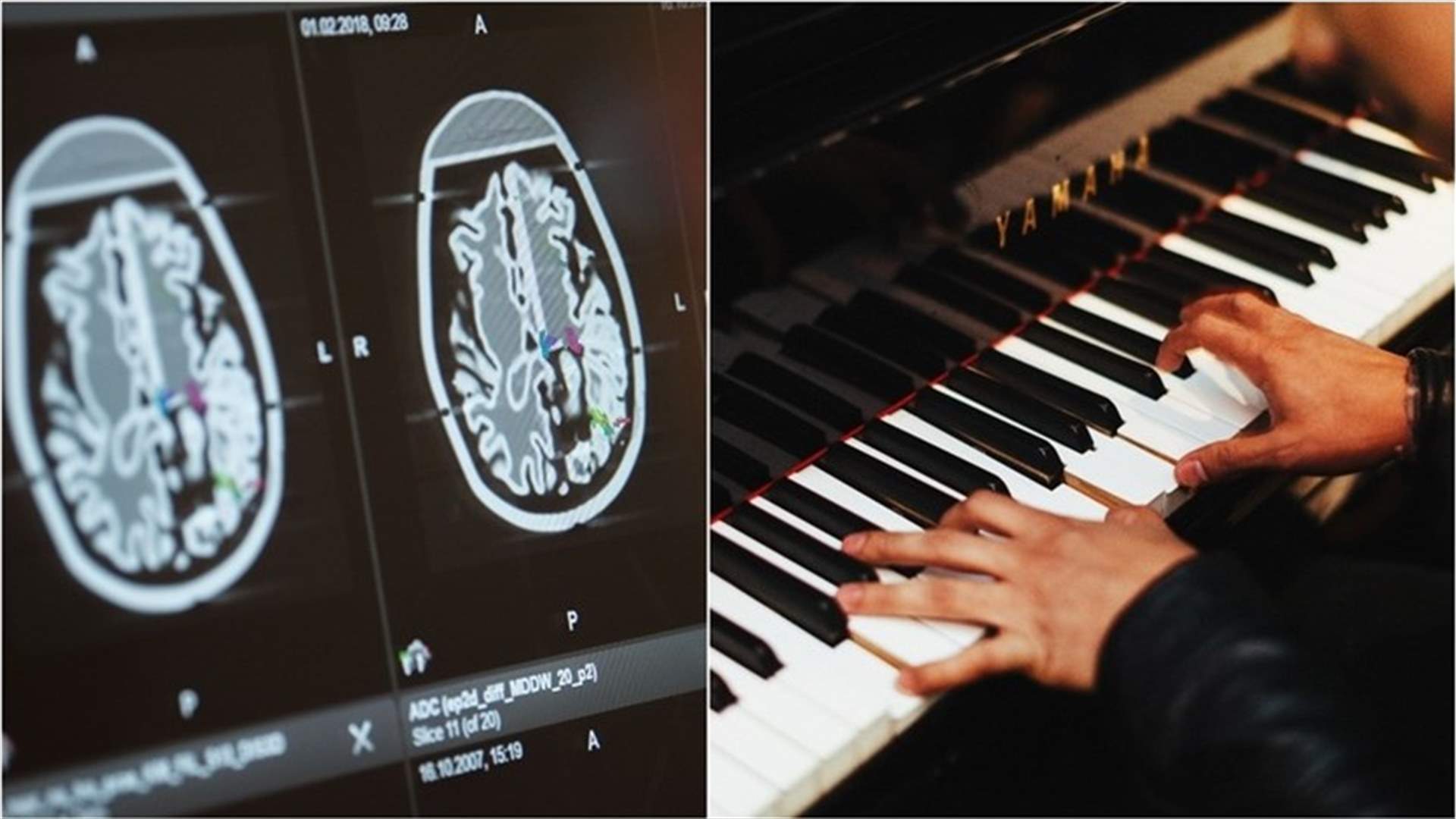 &quot;عاشق الجاز&quot; يعزف على البيانو أثناء إجراء جراحة في دماغه