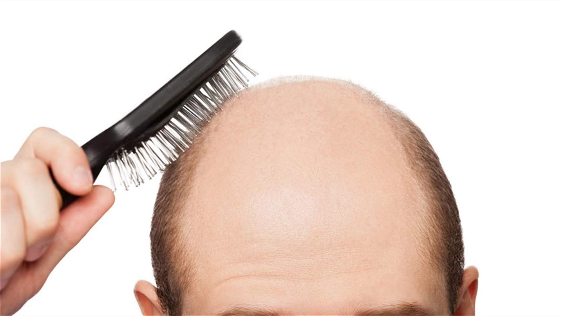 جرعة أمل لعلاج الصلع... إكتشاف جديد بواسطة خلايا جذعية مشتقّة من الدّهون