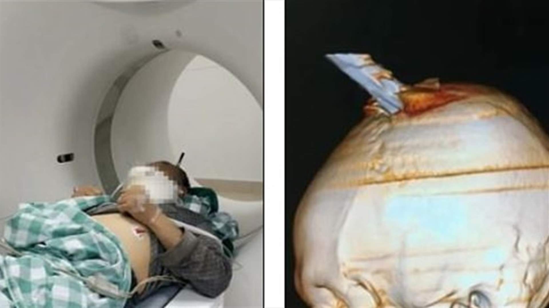 بنّاء صيني ينجو من الموت بأعجوبة بعد اختراق قضيب حديدي رأسه (صورة)