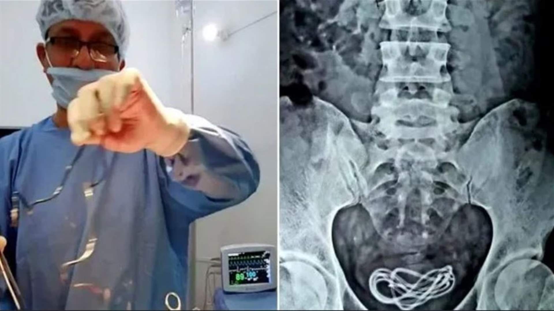 في حادثة غريبة... أطباء يزيلون شاحن هاتف من مثانة رجل