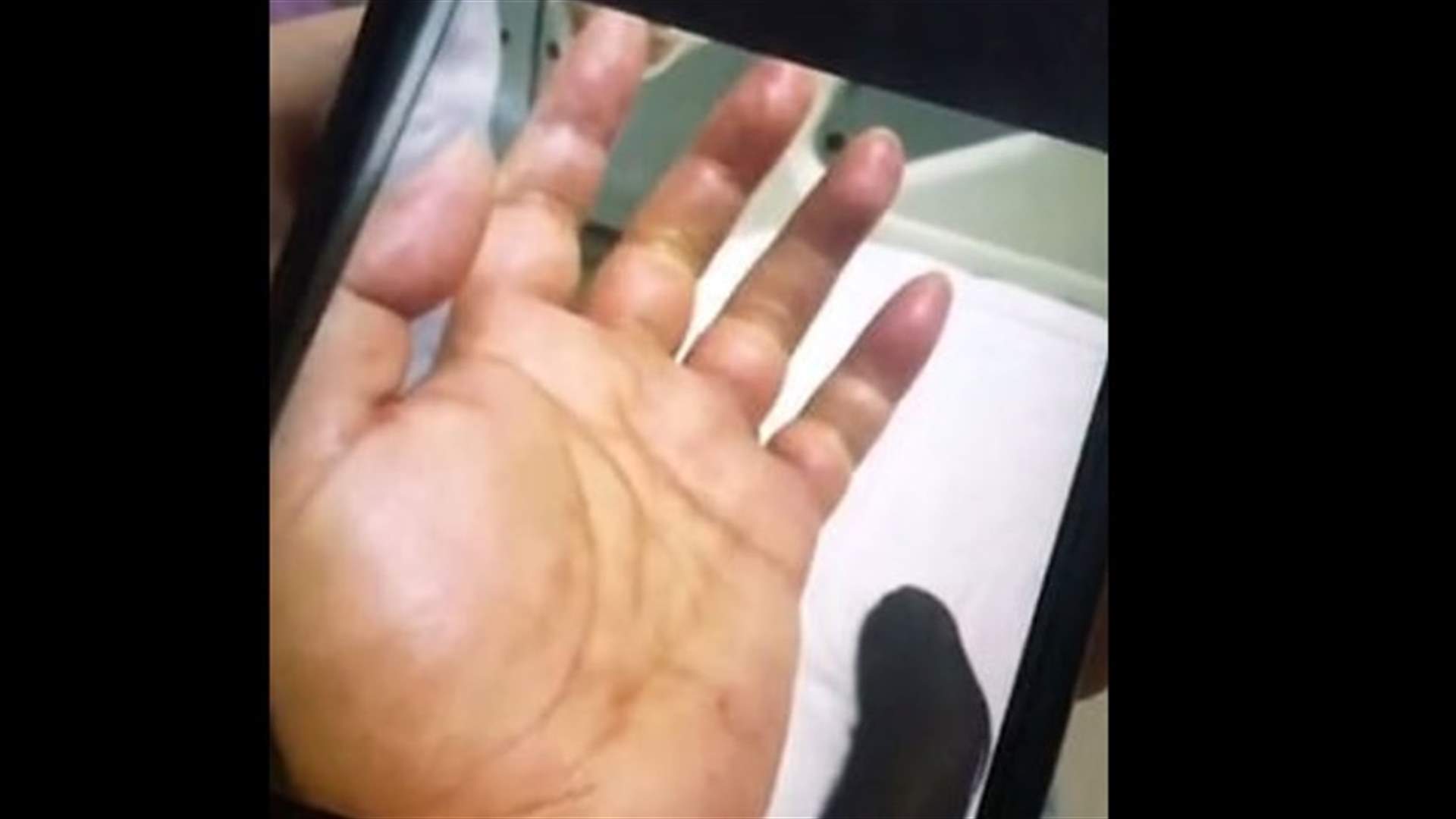 شوكة سمكة كادت أن تتسبب في بتر يد رجل... كان ينظفها من دون قفازات