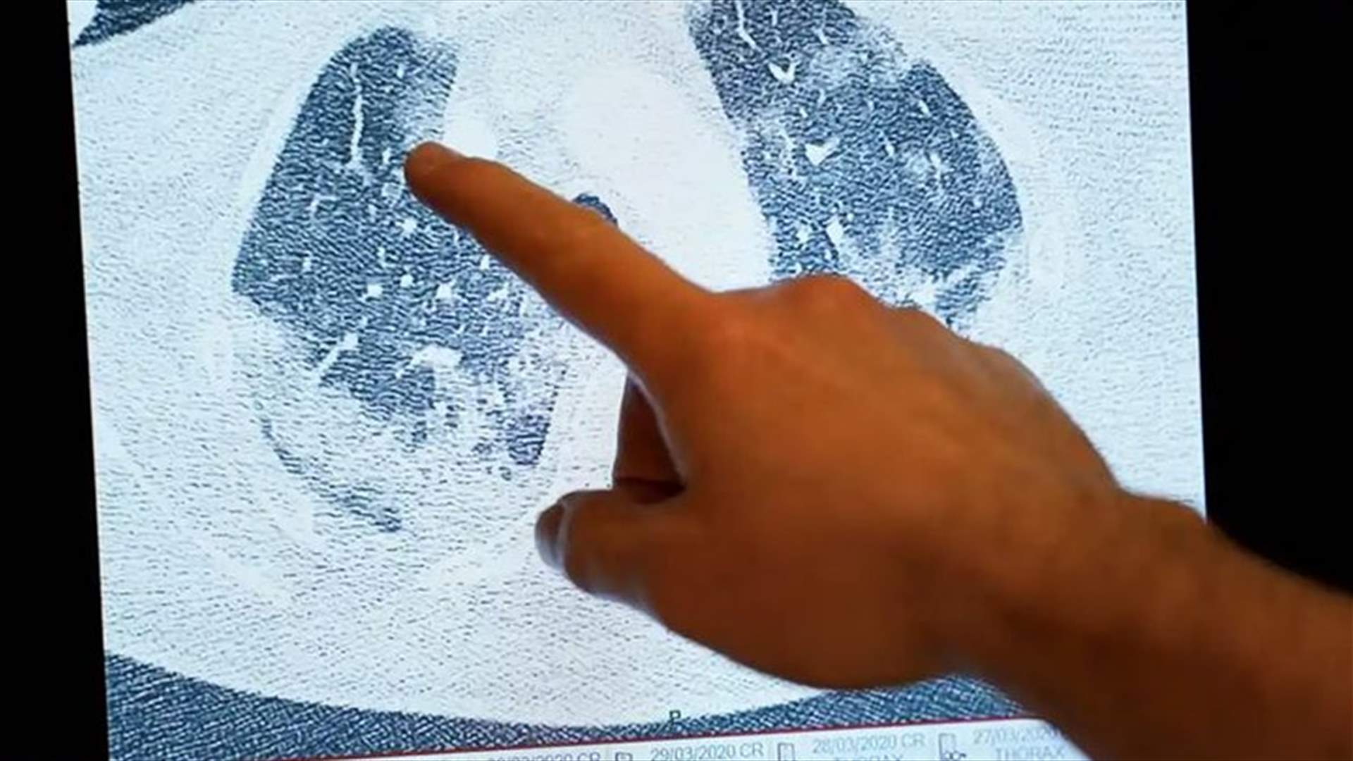 علماء يجرون دراسة على مرضى كورونا المتعافين... تلفٌ في الرئة لأسابيع بعد الخروج من المستشفى