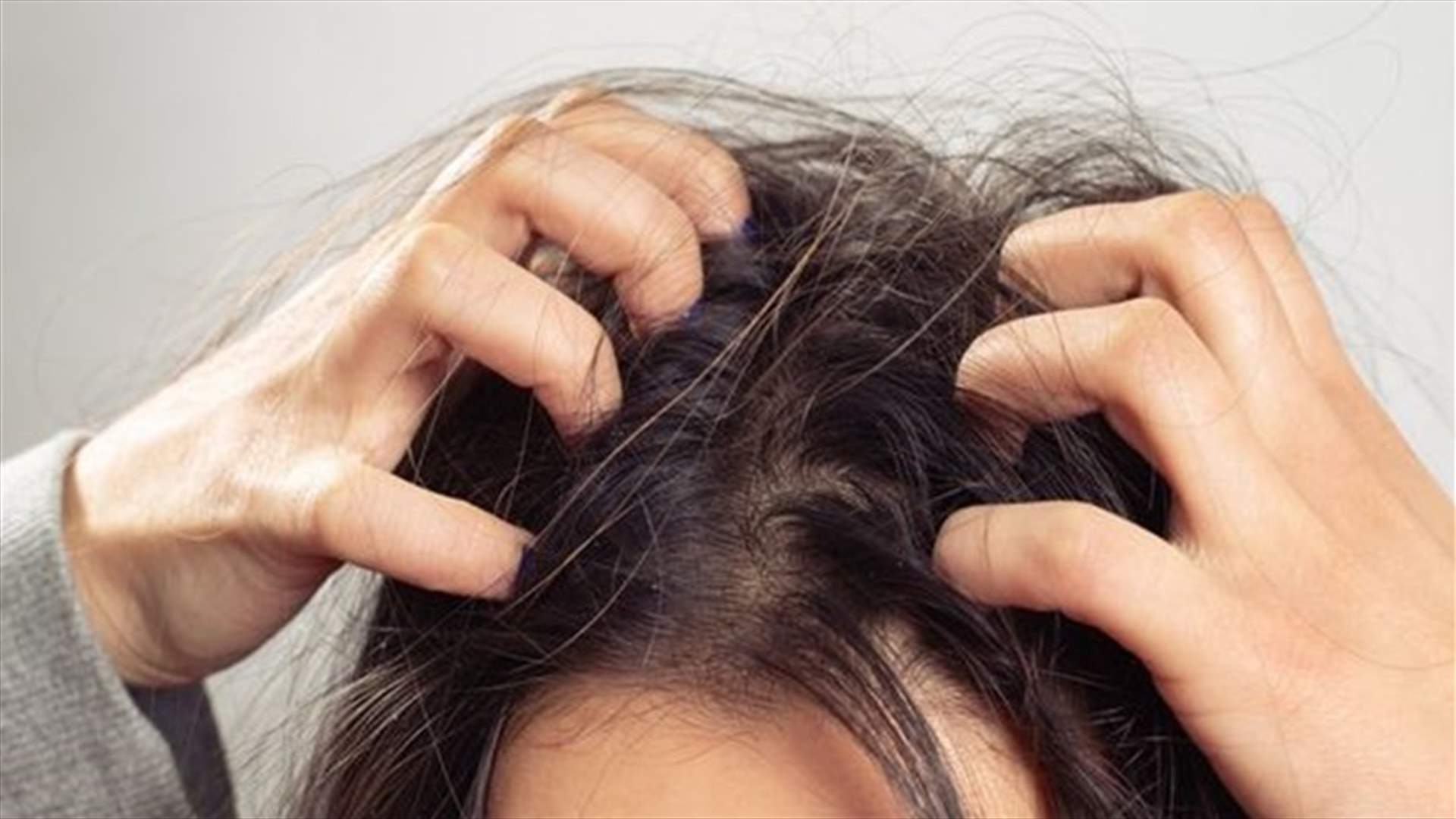 هل تتسبب قشرة الرأس بتساقط الشعر؟