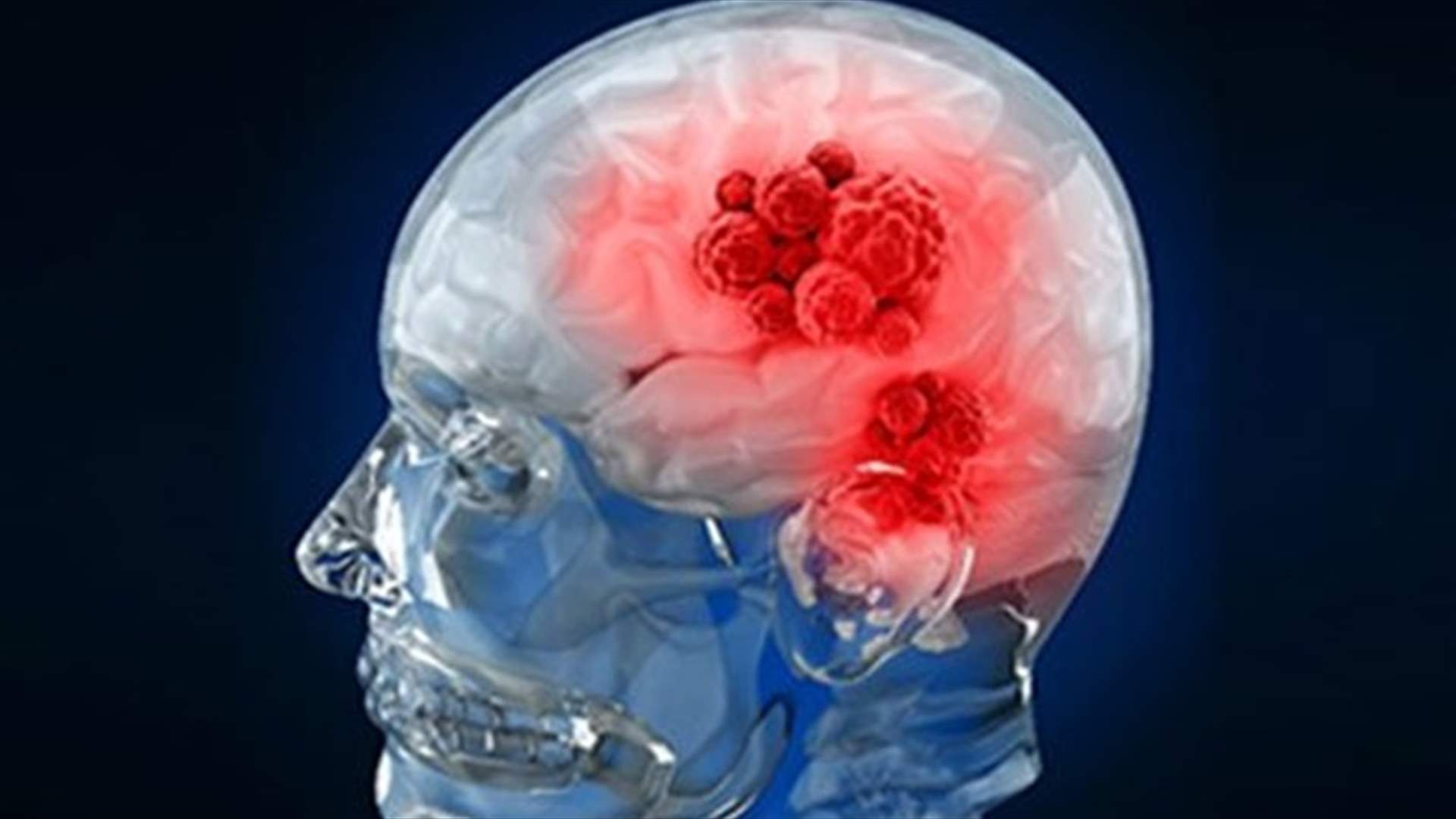 سرطان الدماغ... علامات تشير الى الإصابة بالمرض