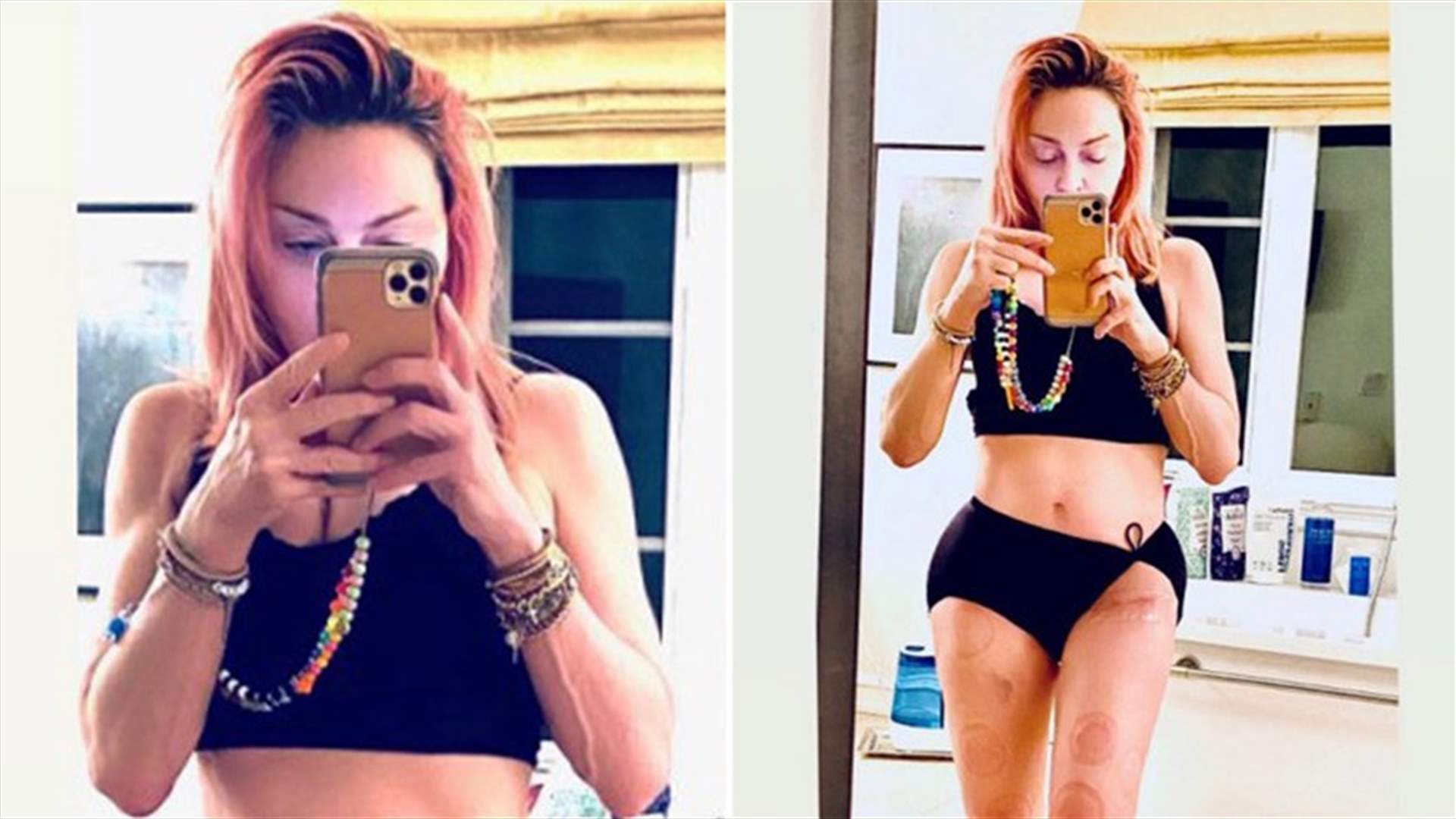 مادونا تستعرض إصابتها بصورة جديدة وتكشف عن الكدمات على ساقيها (صورة)