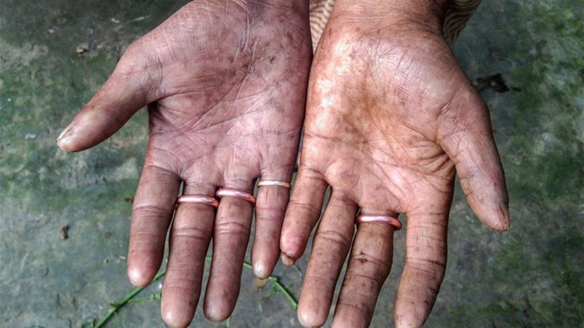 بسبب طفرة جينية نادرة... عائلة ولدت من دون بصمات (صور)