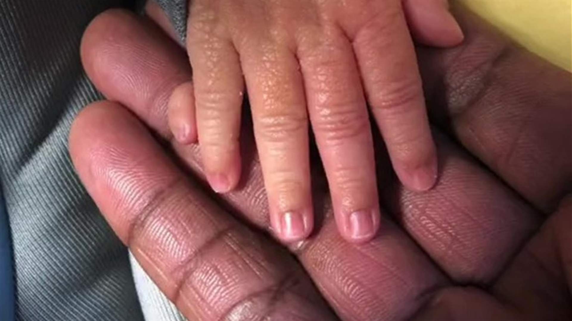 طفلة بـ12 إصبعاً... حالة نادرة تصيب مولودة جديدة وتثير رعب والديها (فيديو)