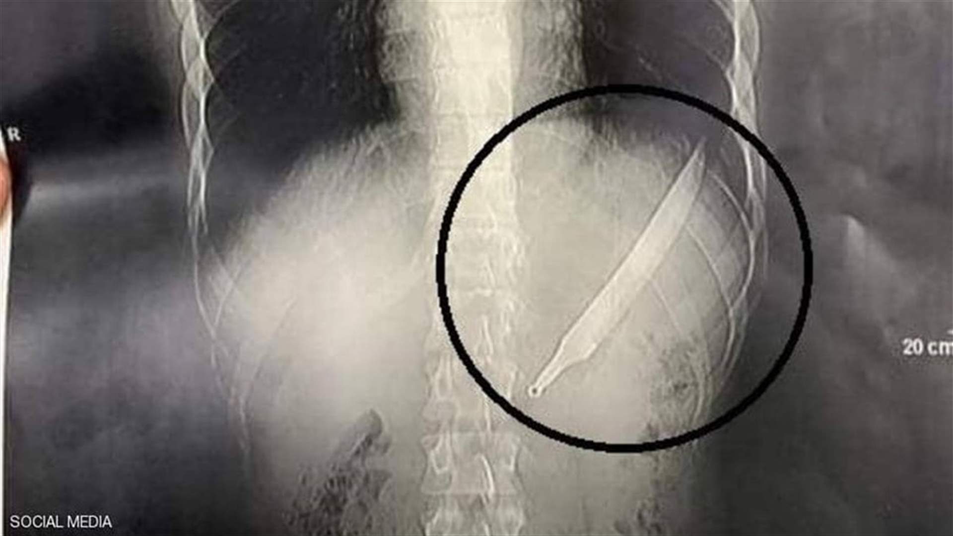 في مصر... أطباء يستخرجون سكيناً طوله 27 سنتيمتراً من جسم مريض (صورة)