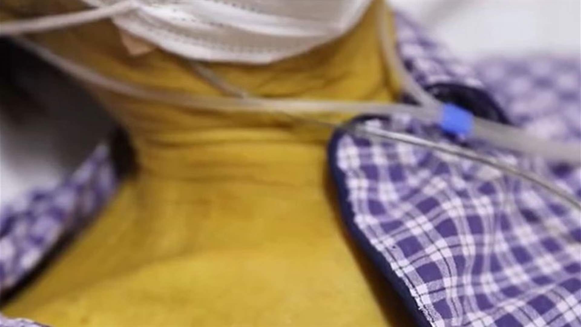 في ظاهرة غريبة... أصيب بورم وتحوّل لون بشرته إلى الأصفر الداكن (صور)