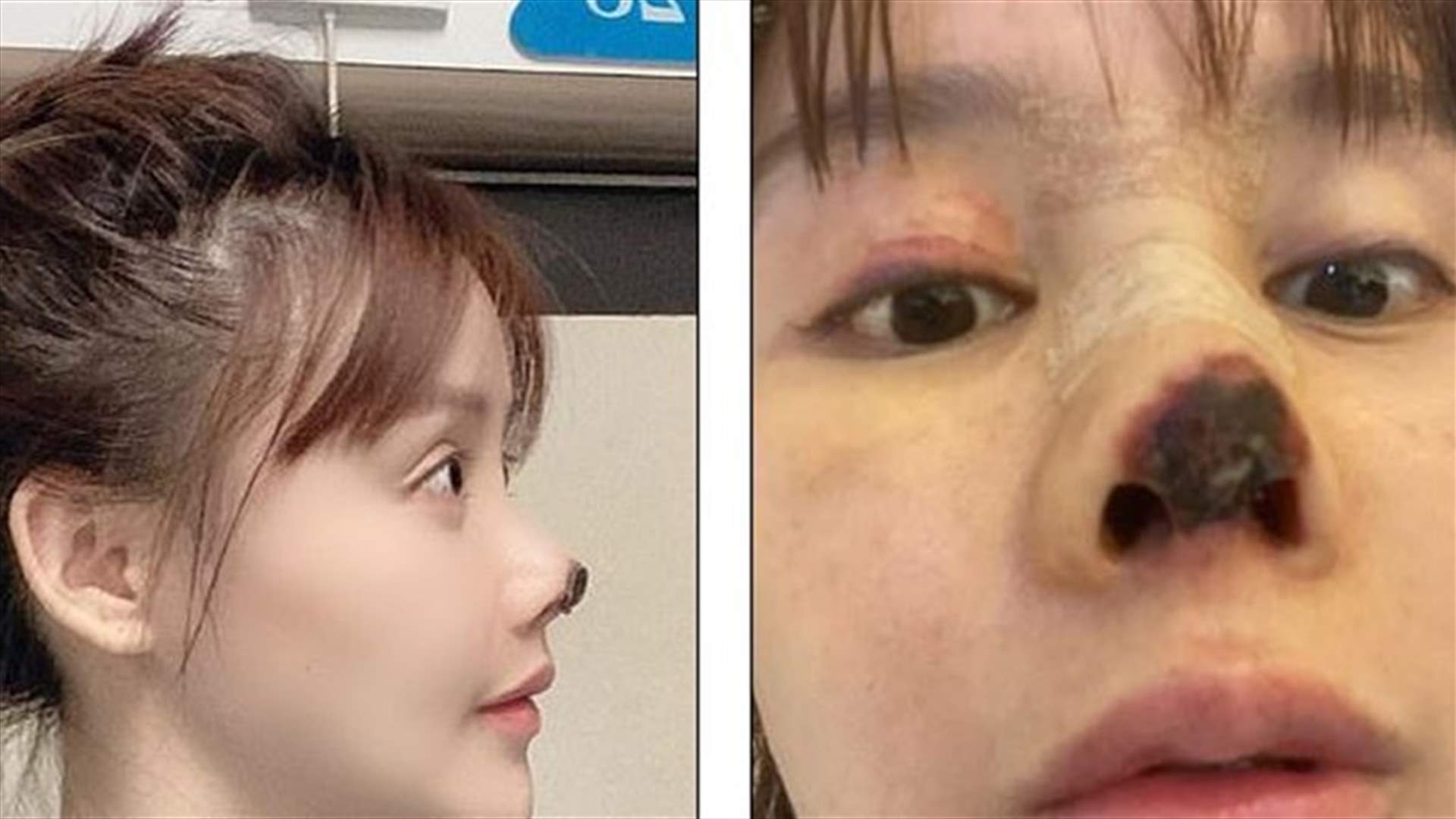 عملية تجميل فاشلة... ممثلة صينية تنشر صوراً لأنفها المشوّه وتحذّر! (صور)