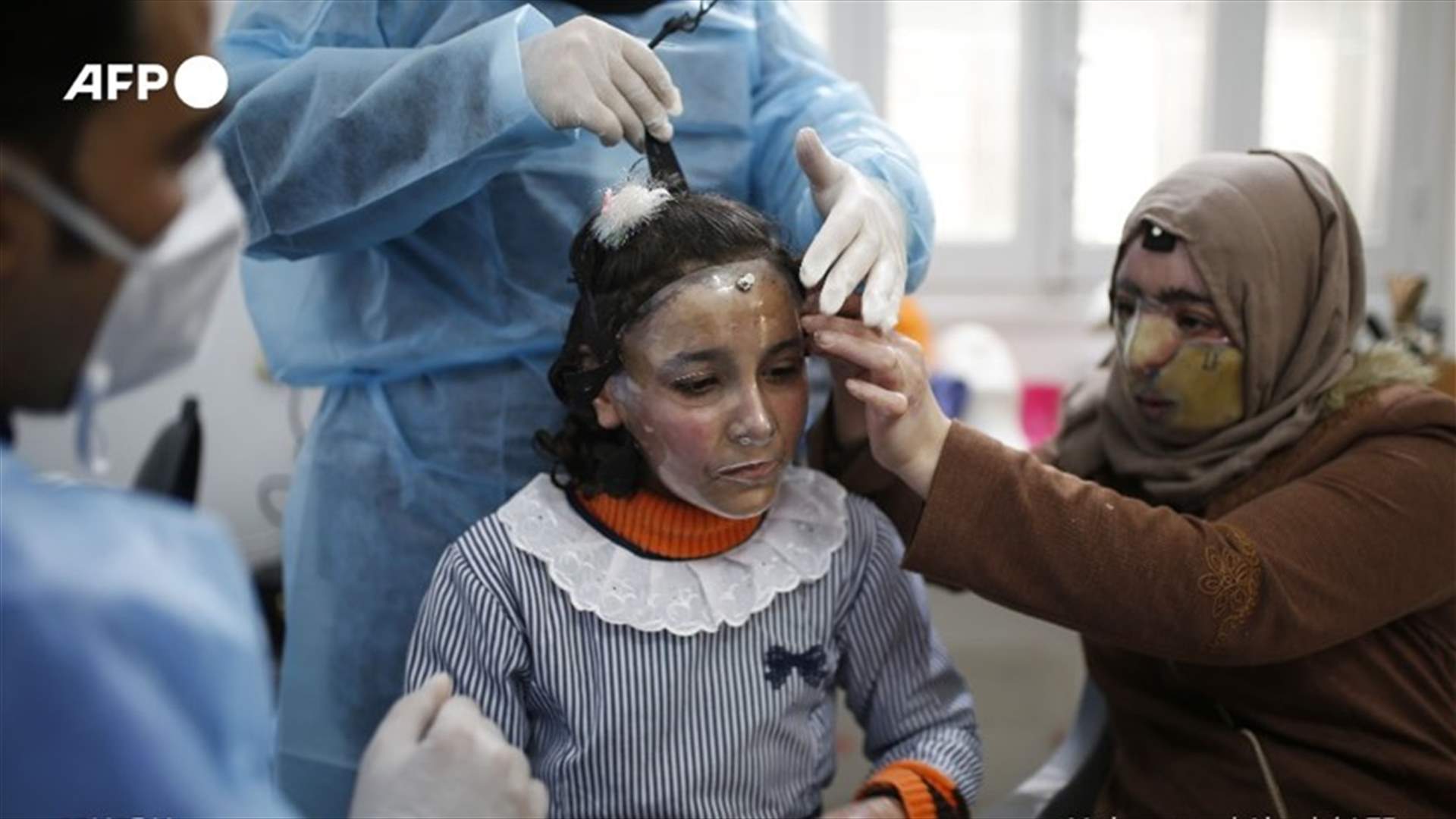 اليكم قصة مرام... أمل لضحايا حروق الوجه في غزة