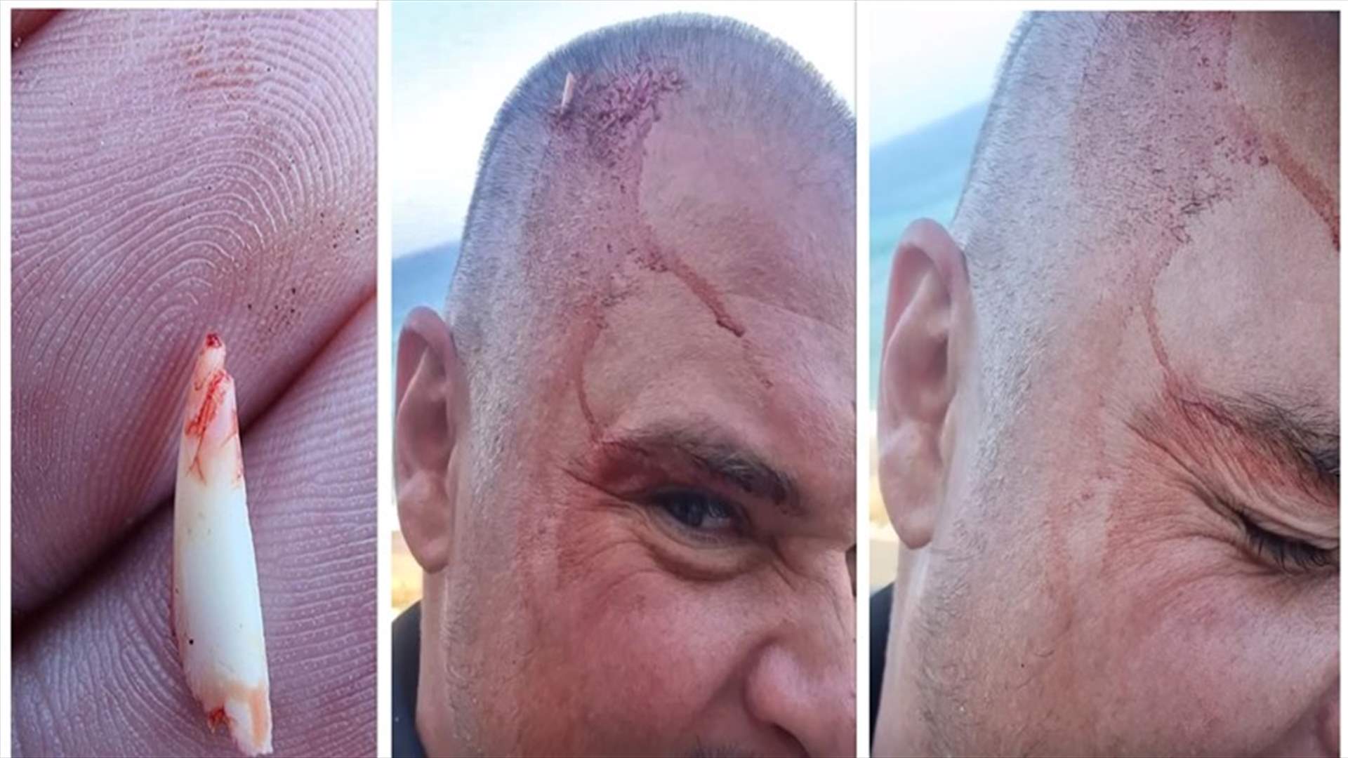 في واقعة غريبة... غواص يتفاجأ بسن سمكة قرش مغروسة برأسه (صور)