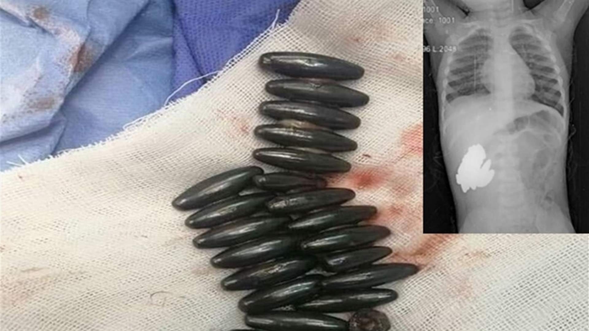 في مصر... استخراج ٣٠ قطعة معدنية من بطن طفلة