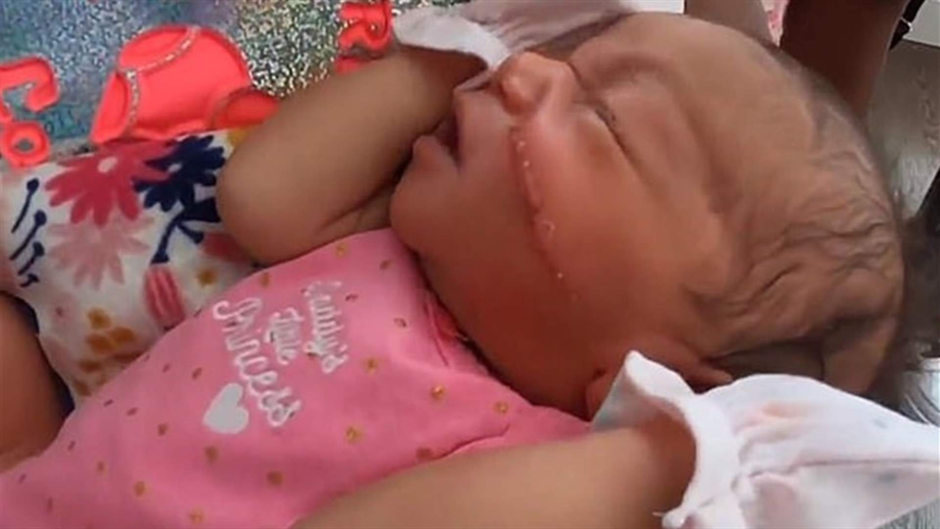 خطأ غير مألوف... ولادة قيصرية طارئة تسبب جرحاً كبيراً في وجه طفلة (فيديو)