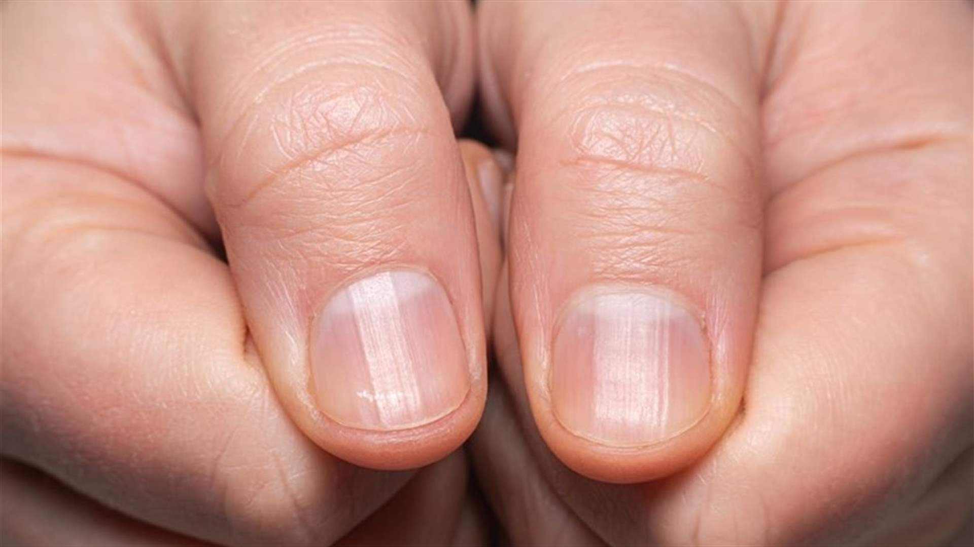 إليكم 5 تغيّرات في الأظافر قد تشير إلى إصابتكم بكوفيد-19