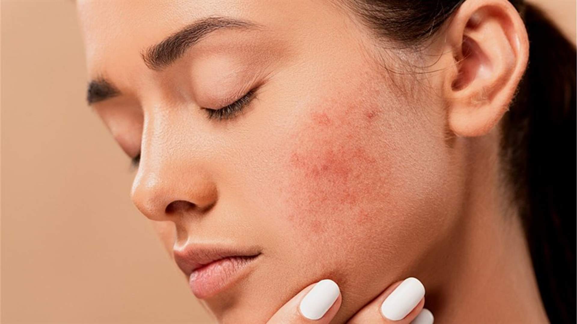إليكم هذه الأطعمة لعلاج حبّ الشباب