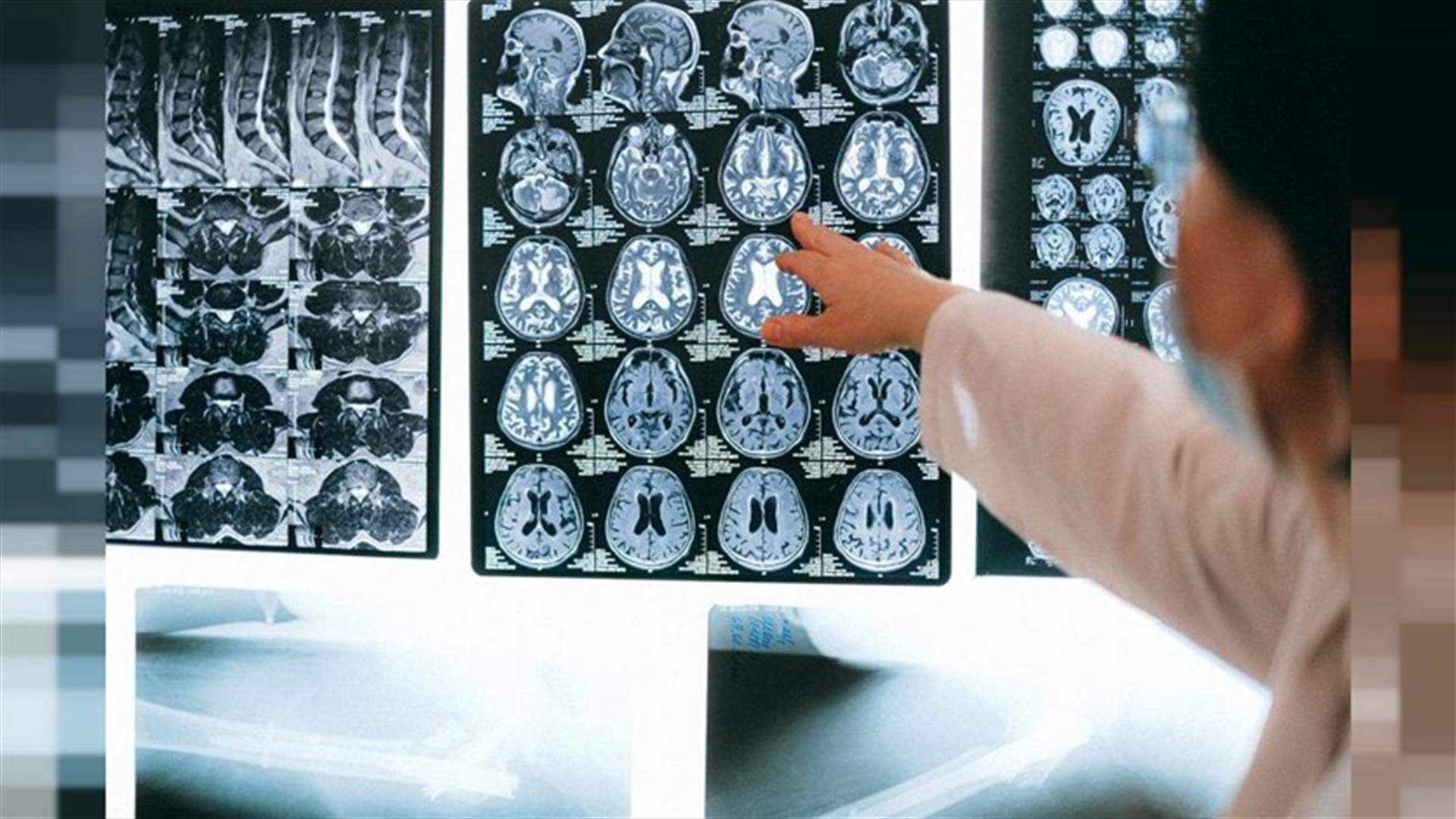 بدقة بلغت 99 في المئة... تقنية جديدة تكشف باكراً عن احتمالية الإصابة بمرض الألزهايمر