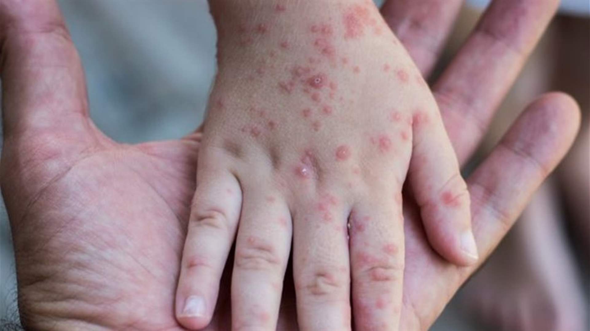 تقرير يحذّر... العالم يواجه خطر تفشي الحصبة بسبب تعطل تطعيم الرضع أثناء كورونا